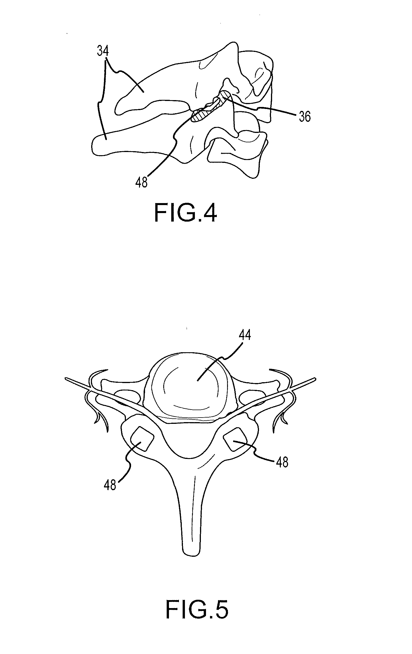 Cervical distraction/implant delivery device