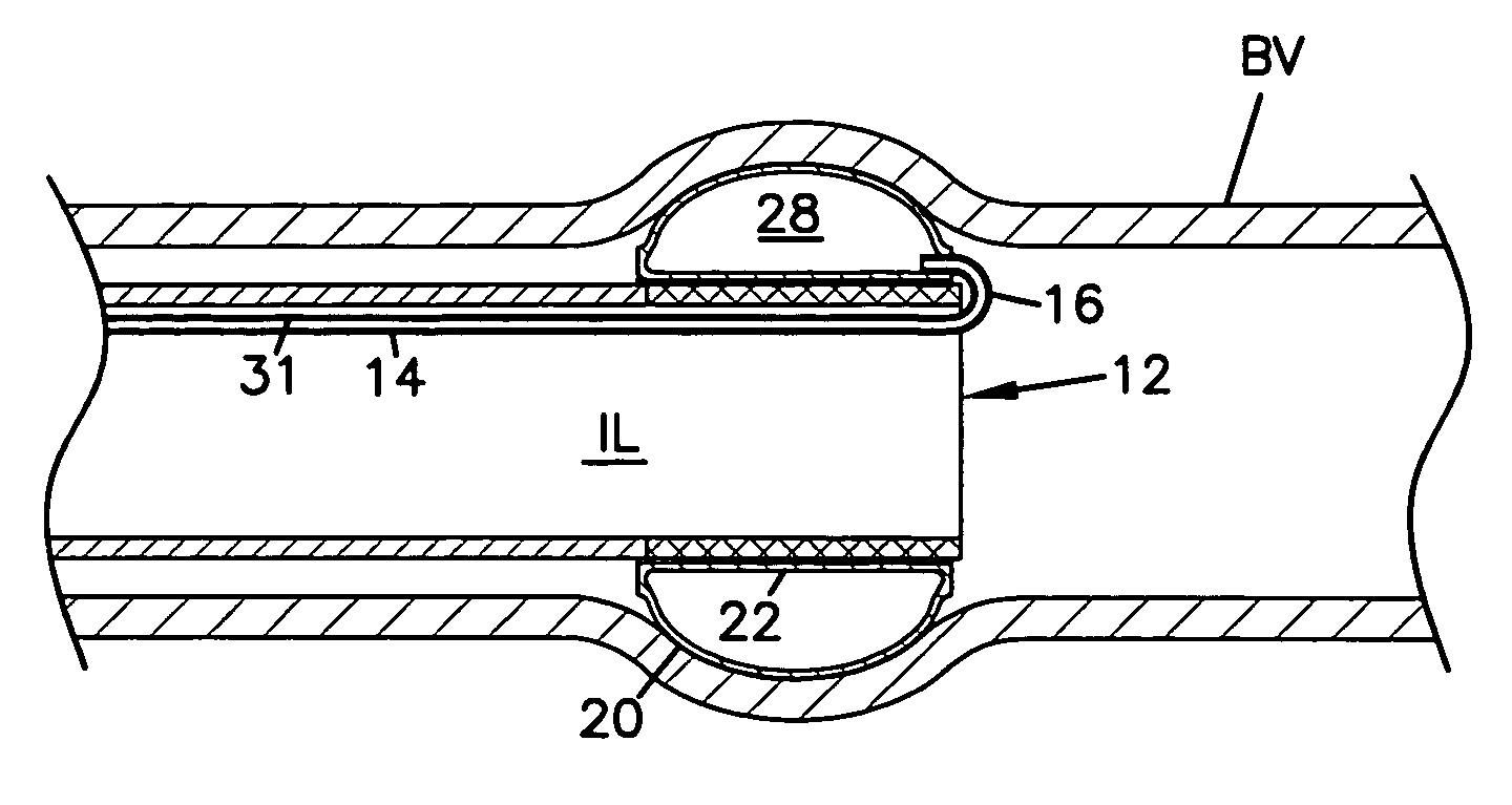 Vascular clip-on occlusion system