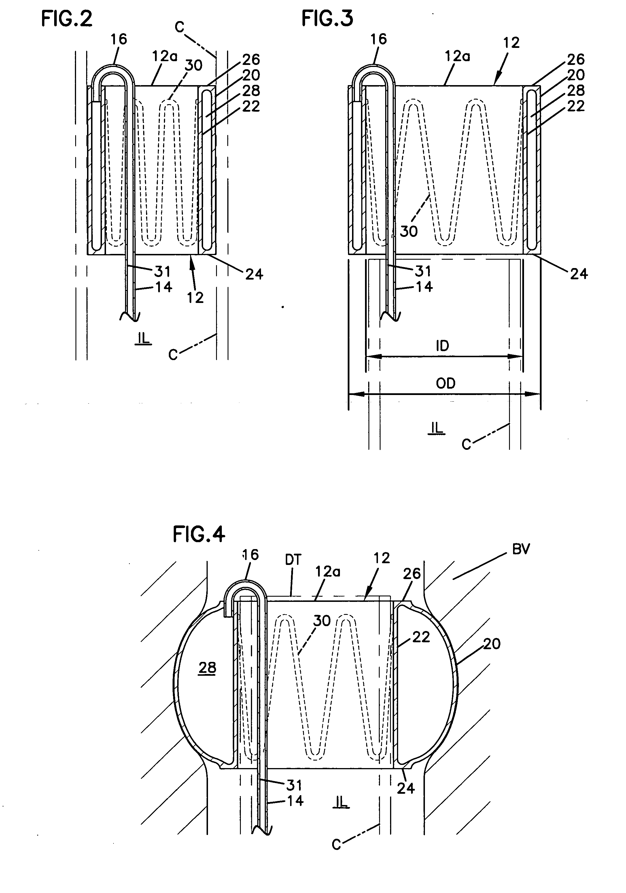 Vascular clip-on occlusion system