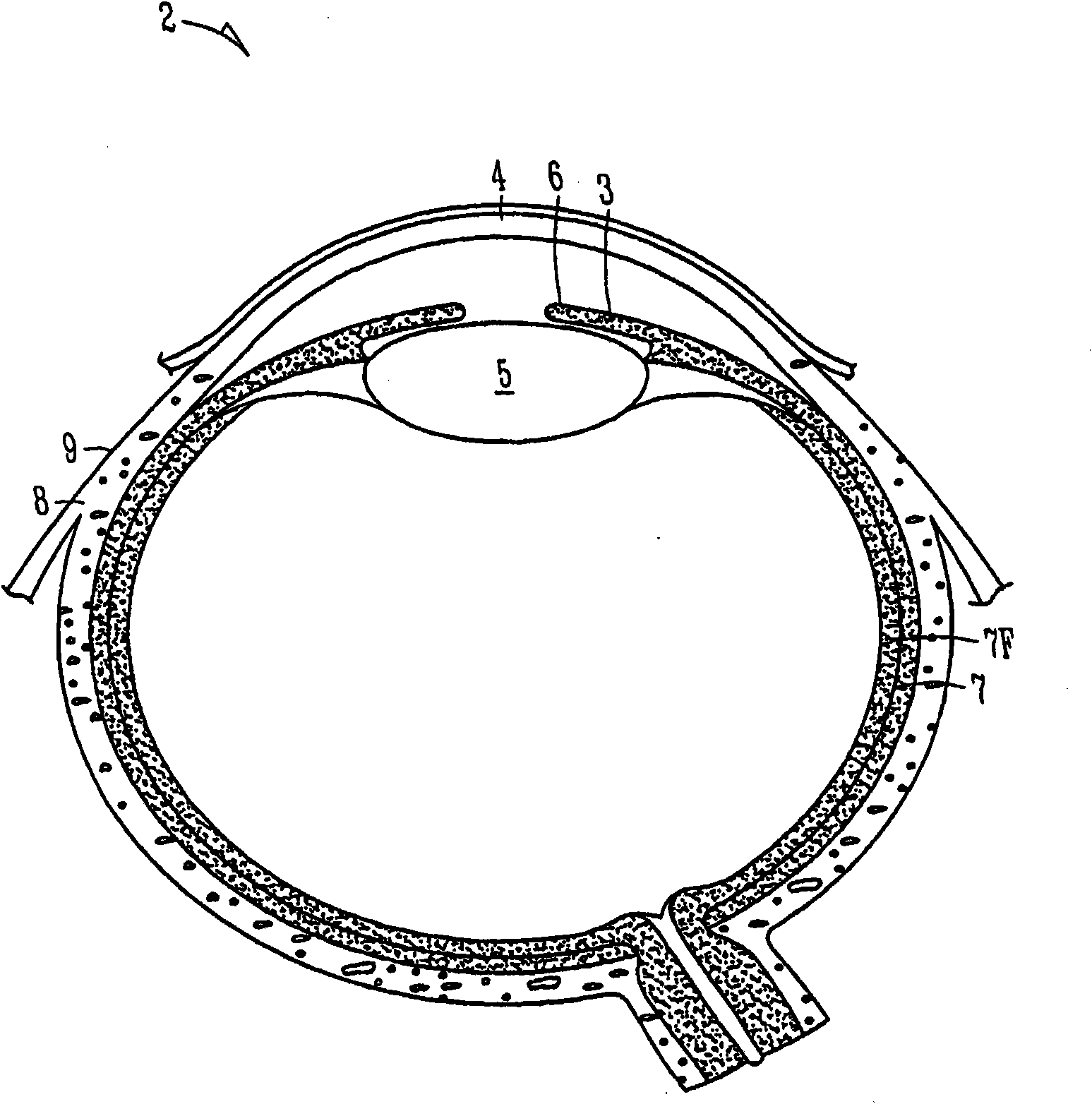 Insertion and extraction tools for lacrimal implants