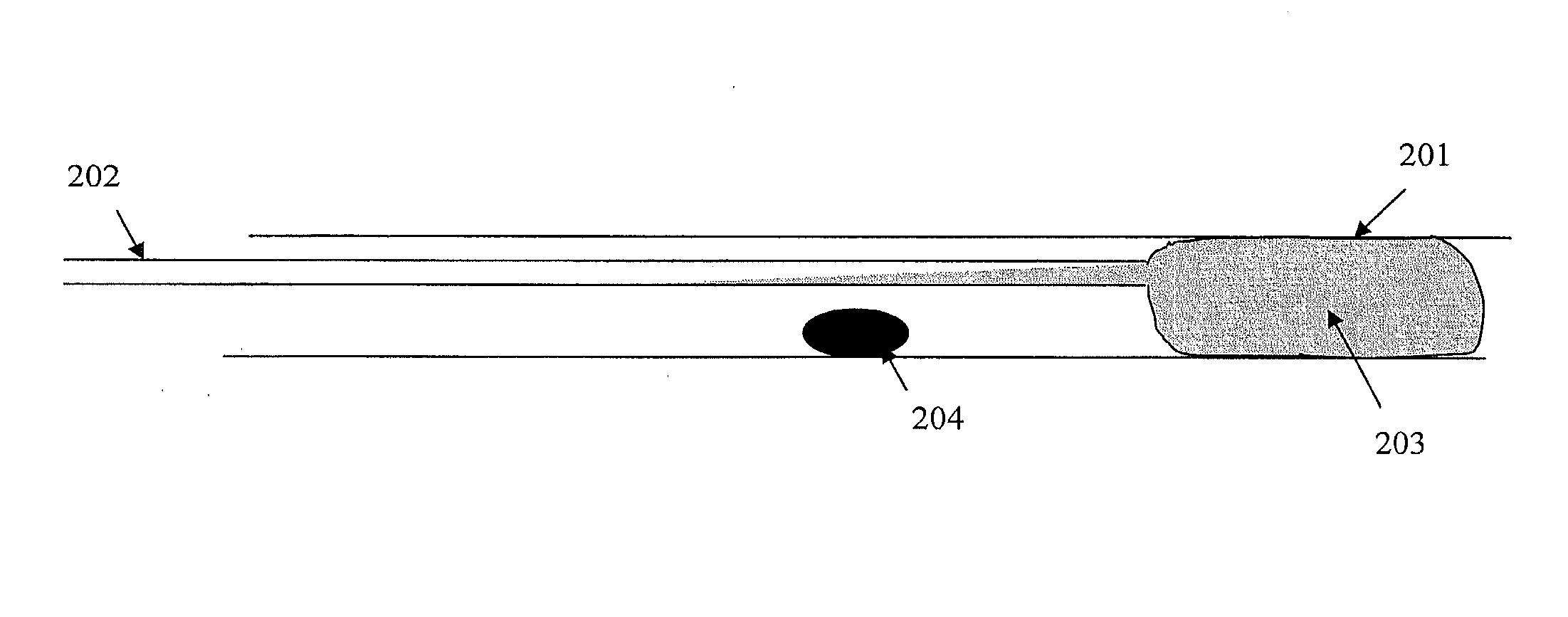 Confinement of Kidney Stone Fragments During Lithotripsy