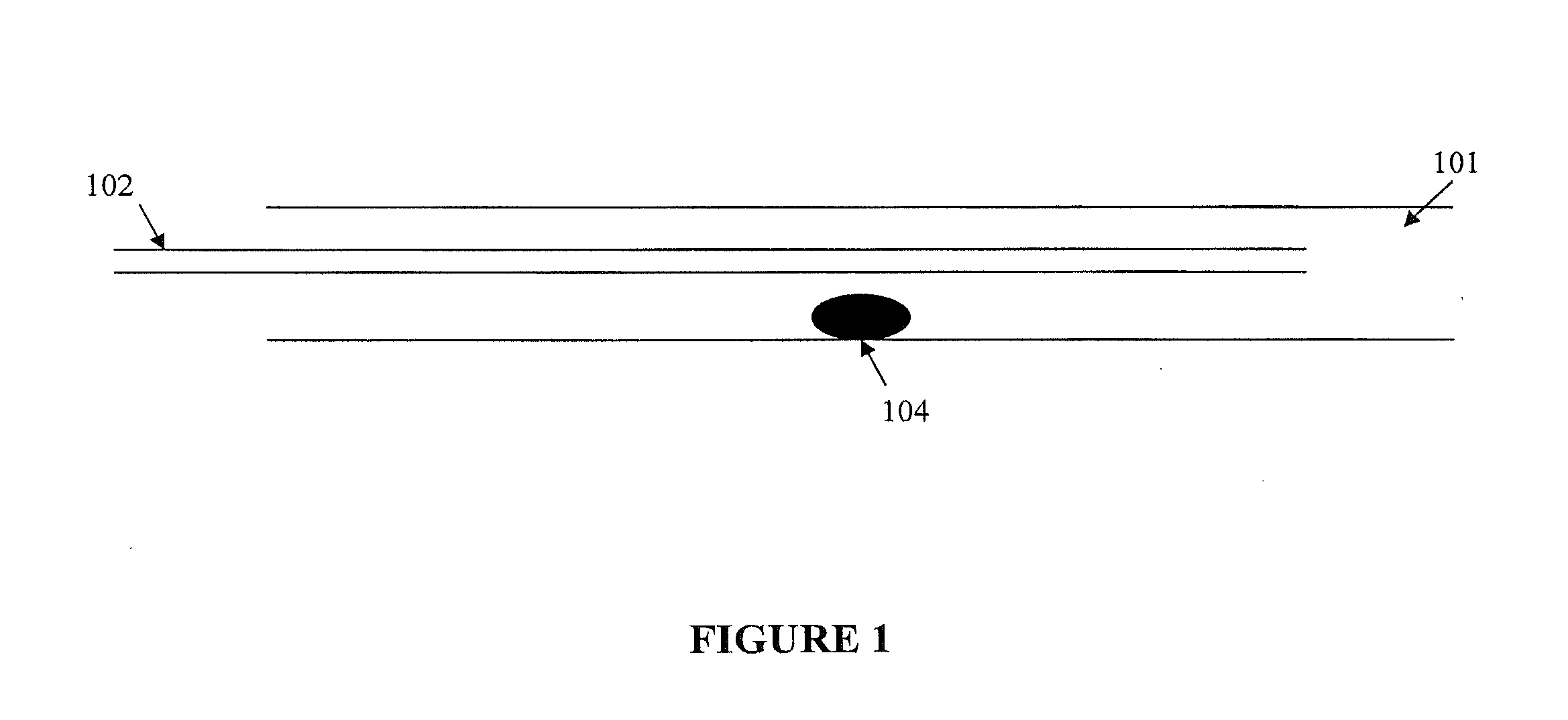 Confinement of Kidney Stone Fragments During Lithotripsy