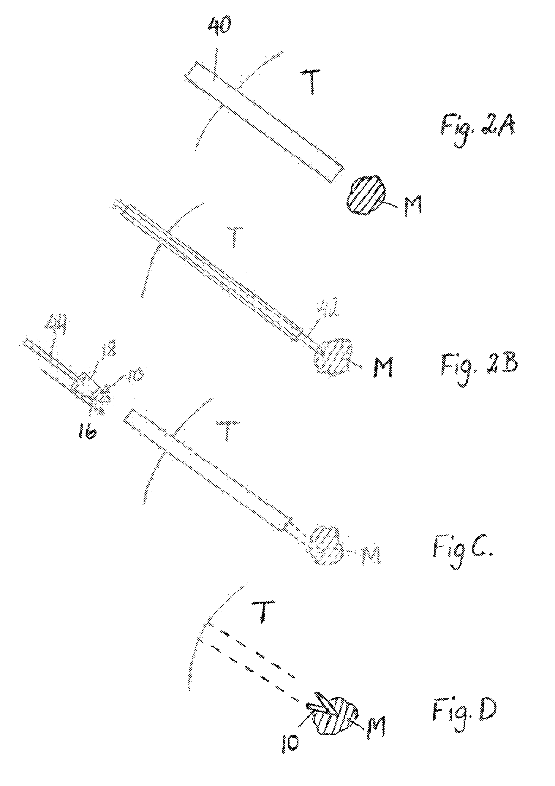 Malignancy removal with tissue adhesive secured structure