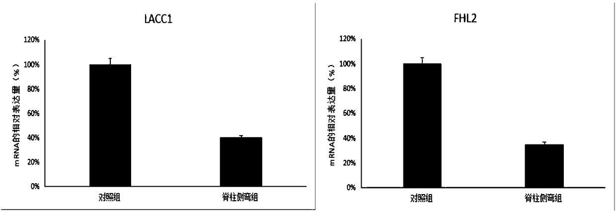 Application of lacc1 and fhl2 genes in the preparation of scoliosis detection products