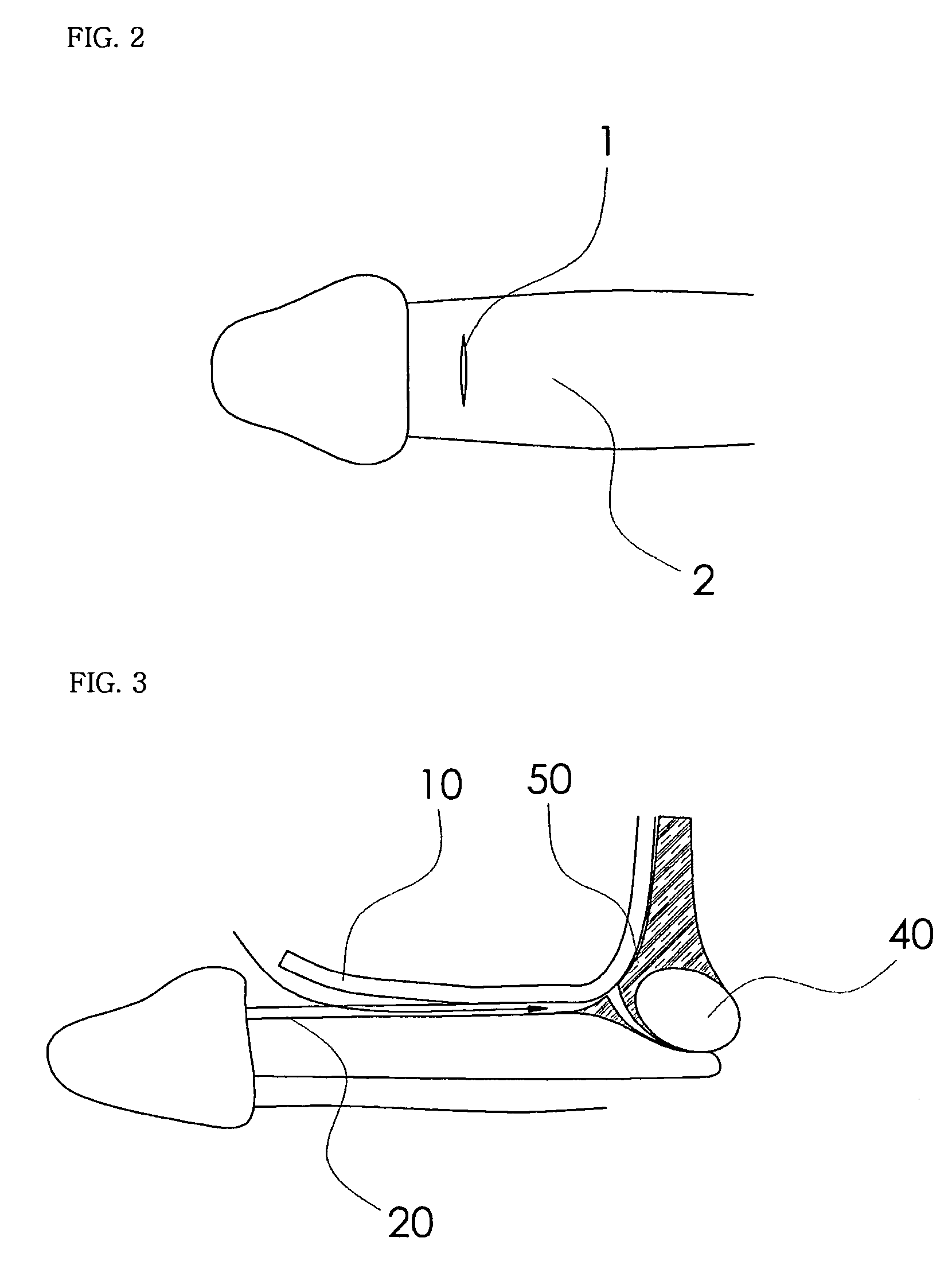 Method for complex phalloplasty with minimal incision