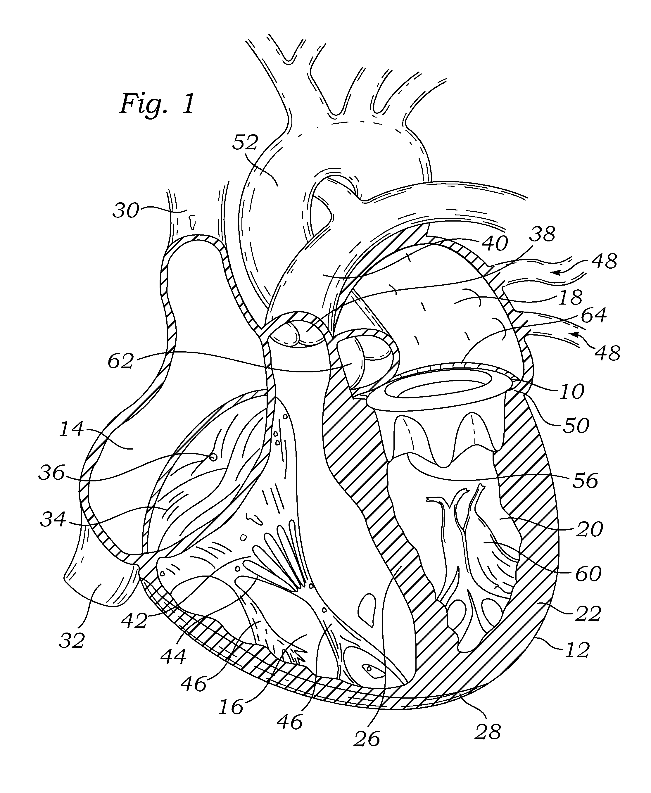 Surgical heart valves adapted for post-implant expansion