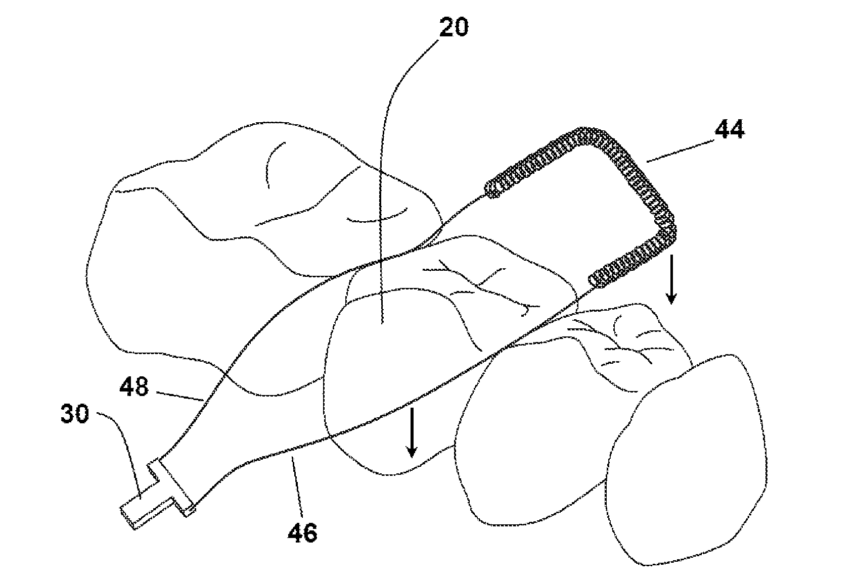 Gingival retraction system