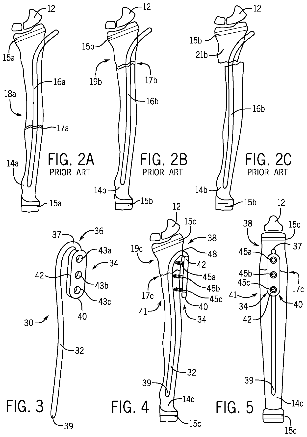 Fracture fixation device having clip for stabilizing intramedullary nail