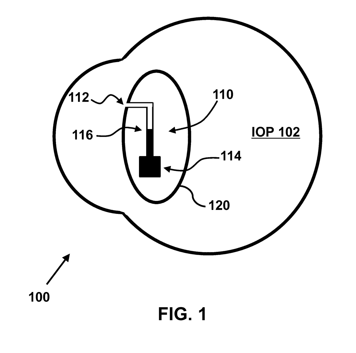 Implantable micro-fluidic device for monitoring of intra-ocular pressure