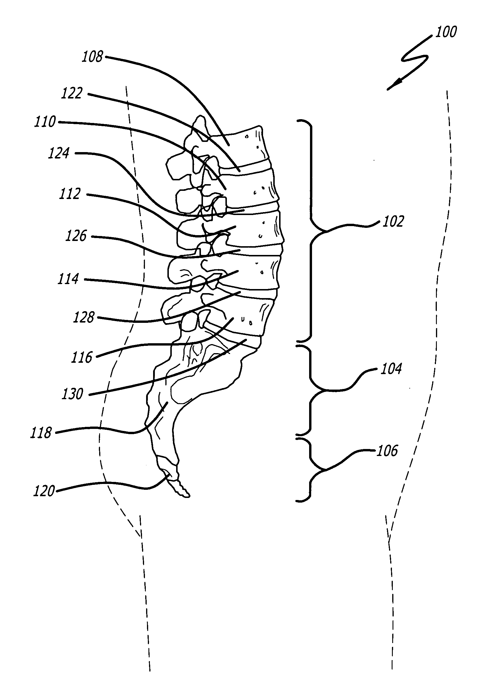 Method of deformity correction in a spine using injectable materials