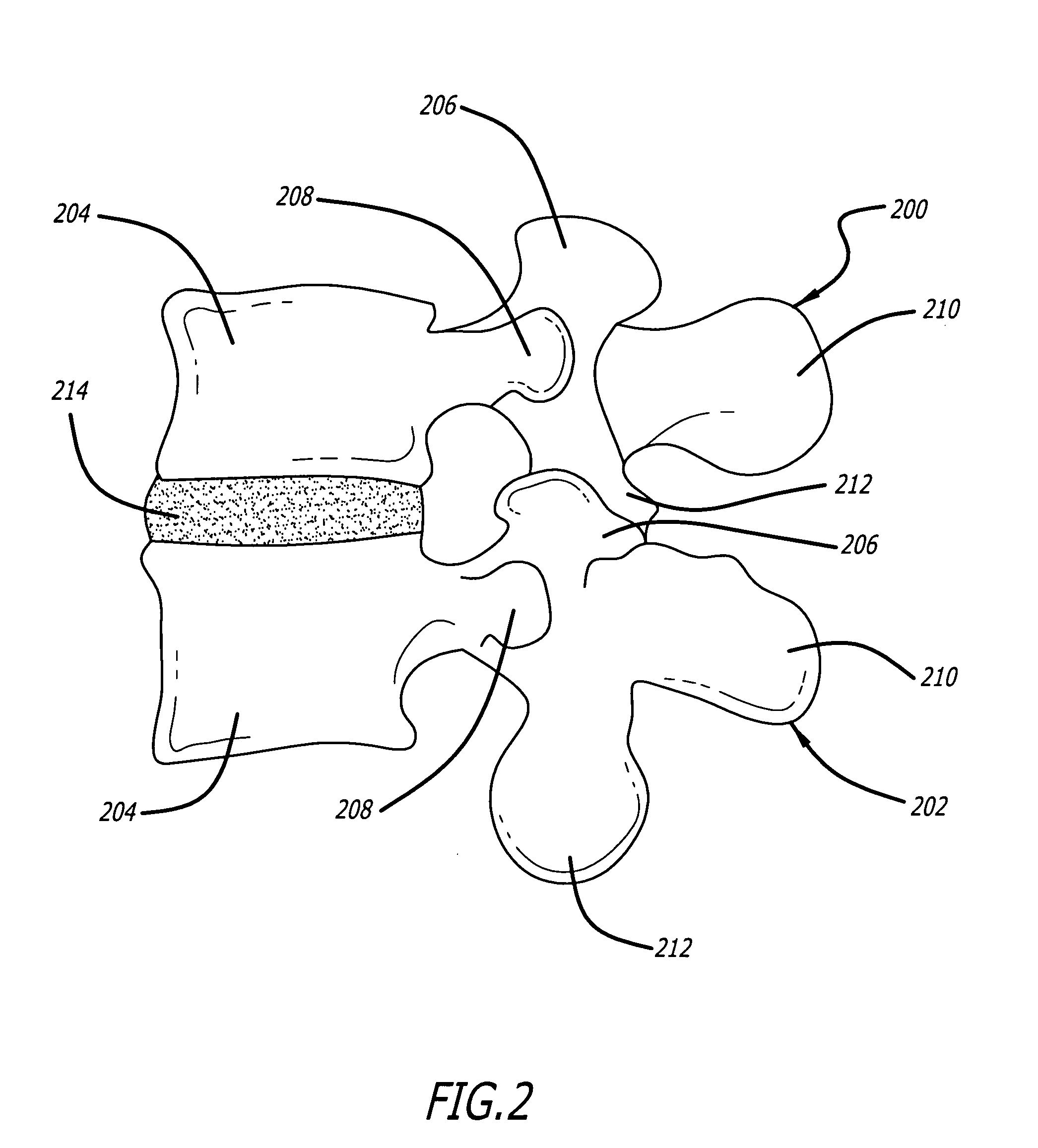 Method of deformity correction in a spine using injectable materials