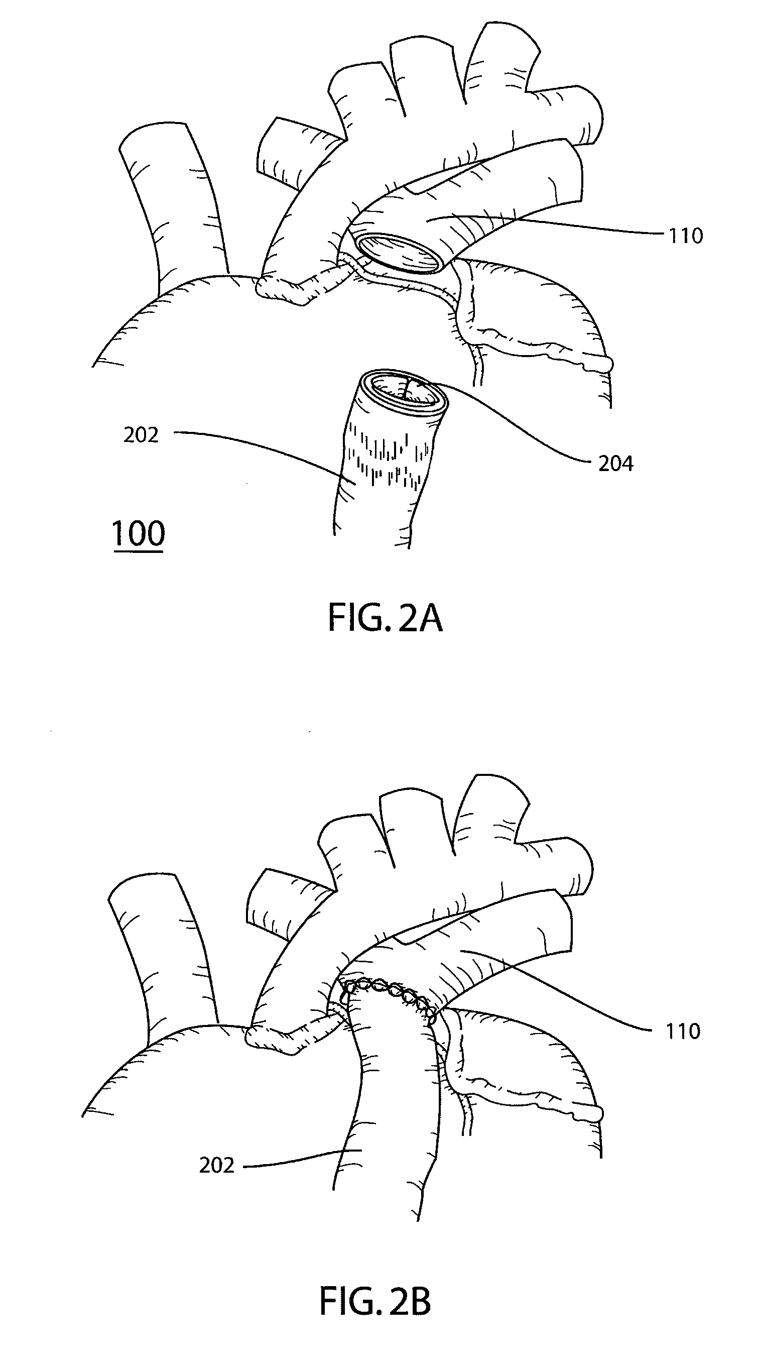 Stented Valve Having Dull Struts