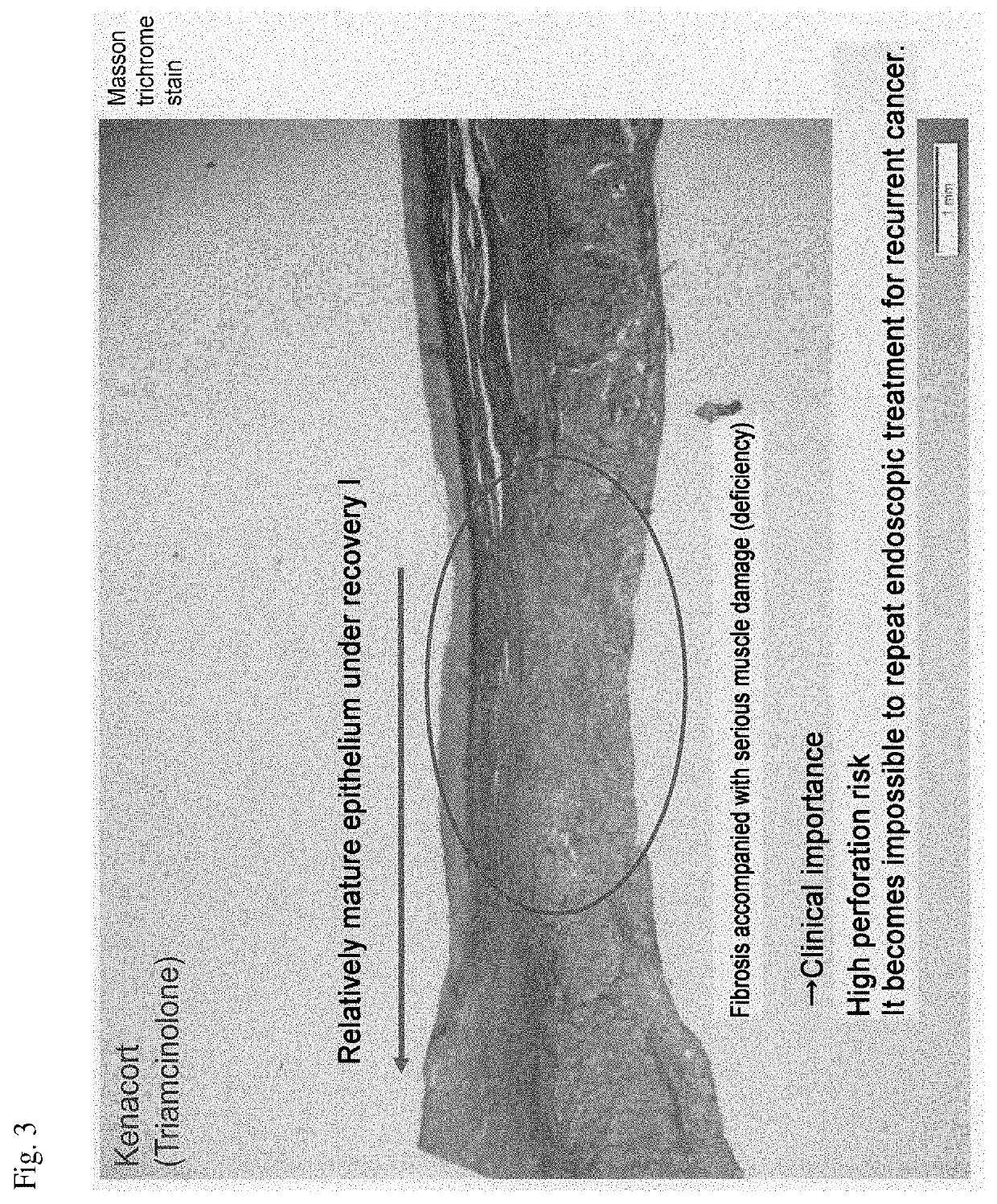 Esophageal stricture suppressing agent