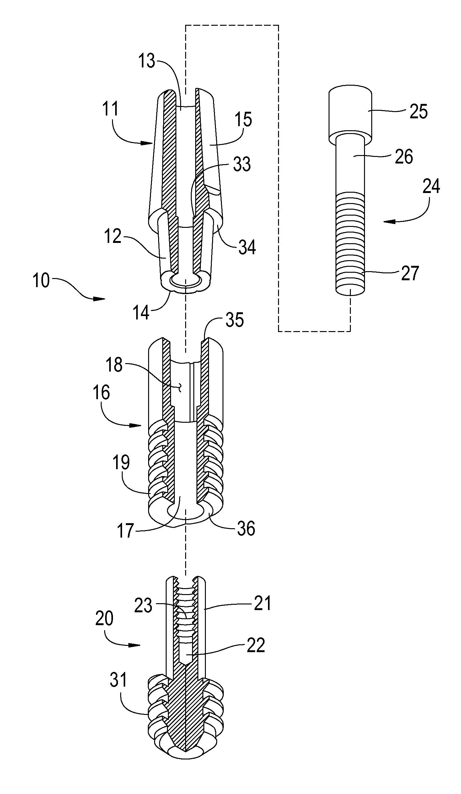 Ceramic and metal composite dental implant