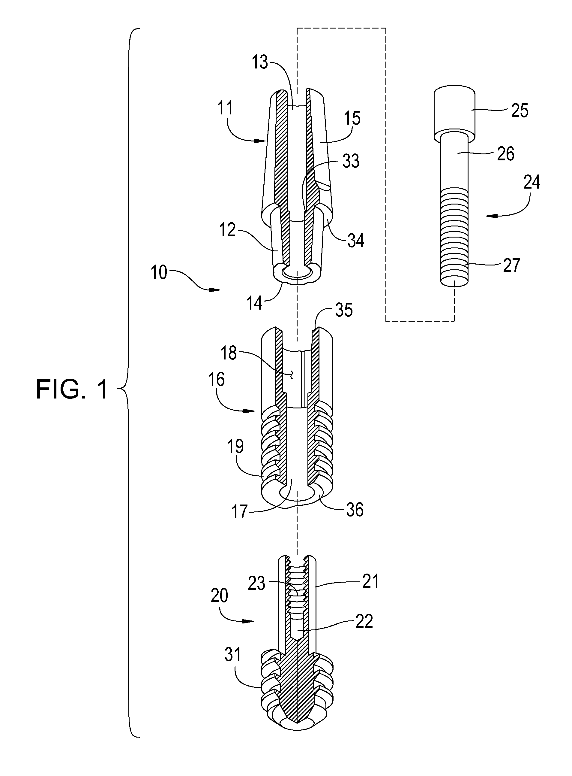 Ceramic and metal composite dental implant