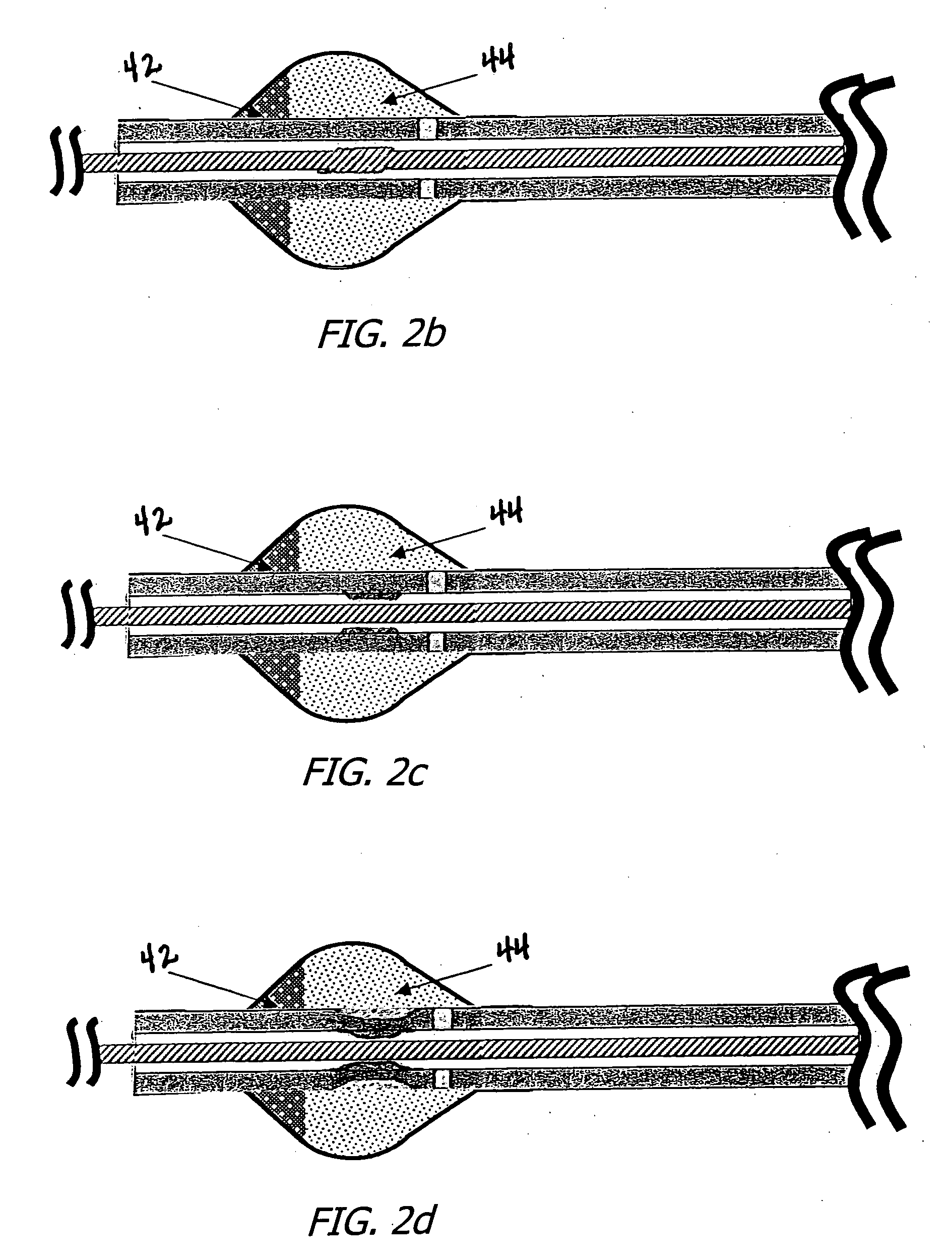 Catheter mounted automatic vessel occlusion and fluid dispersion devices