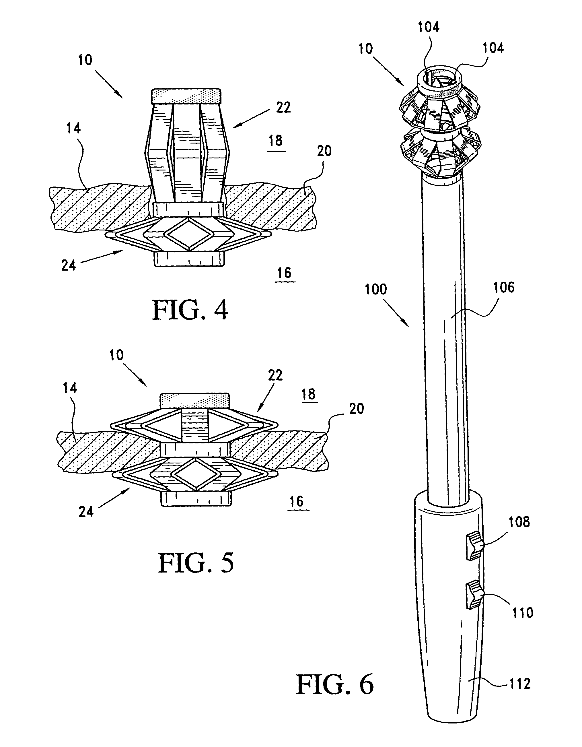 Method and apparatus for sealing a gastric opening