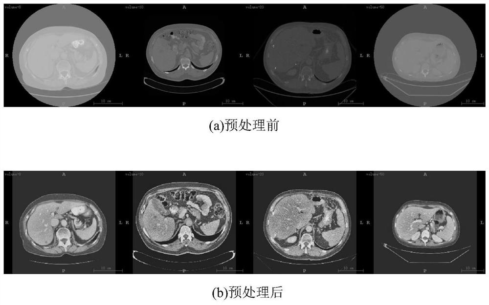 A method for semantic segmentation of 3D liver images based on contextual attention strategy