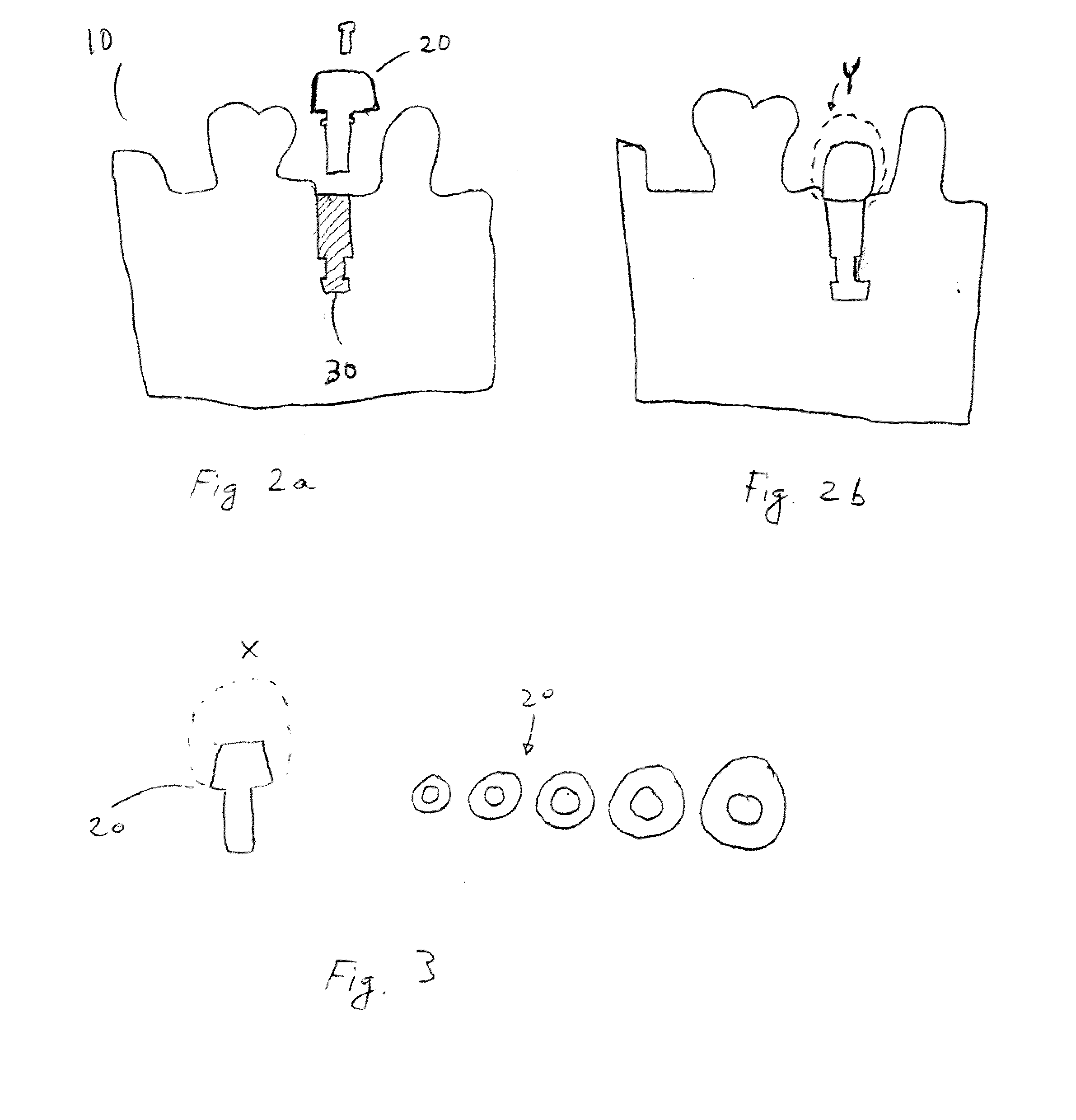 System and method for mass custom manufacturing of dental crowns and crown components