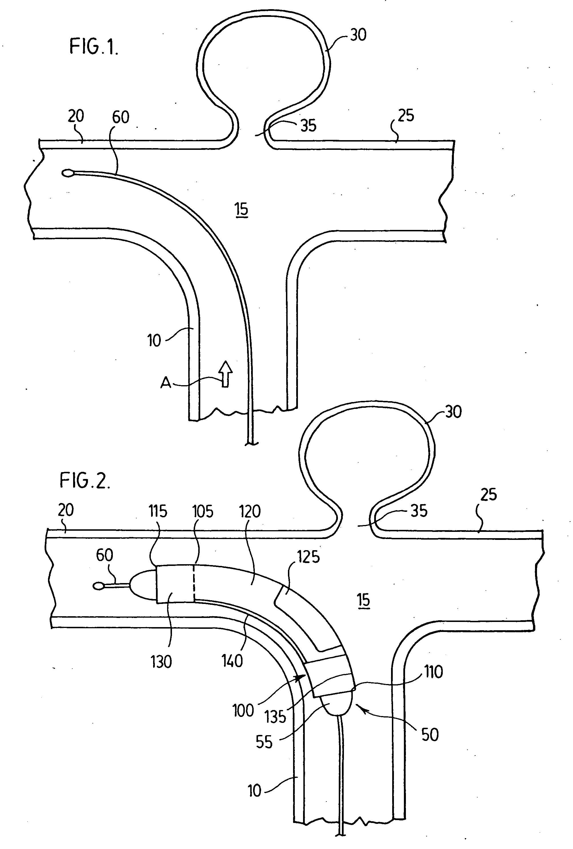 Endovascular prosthesis