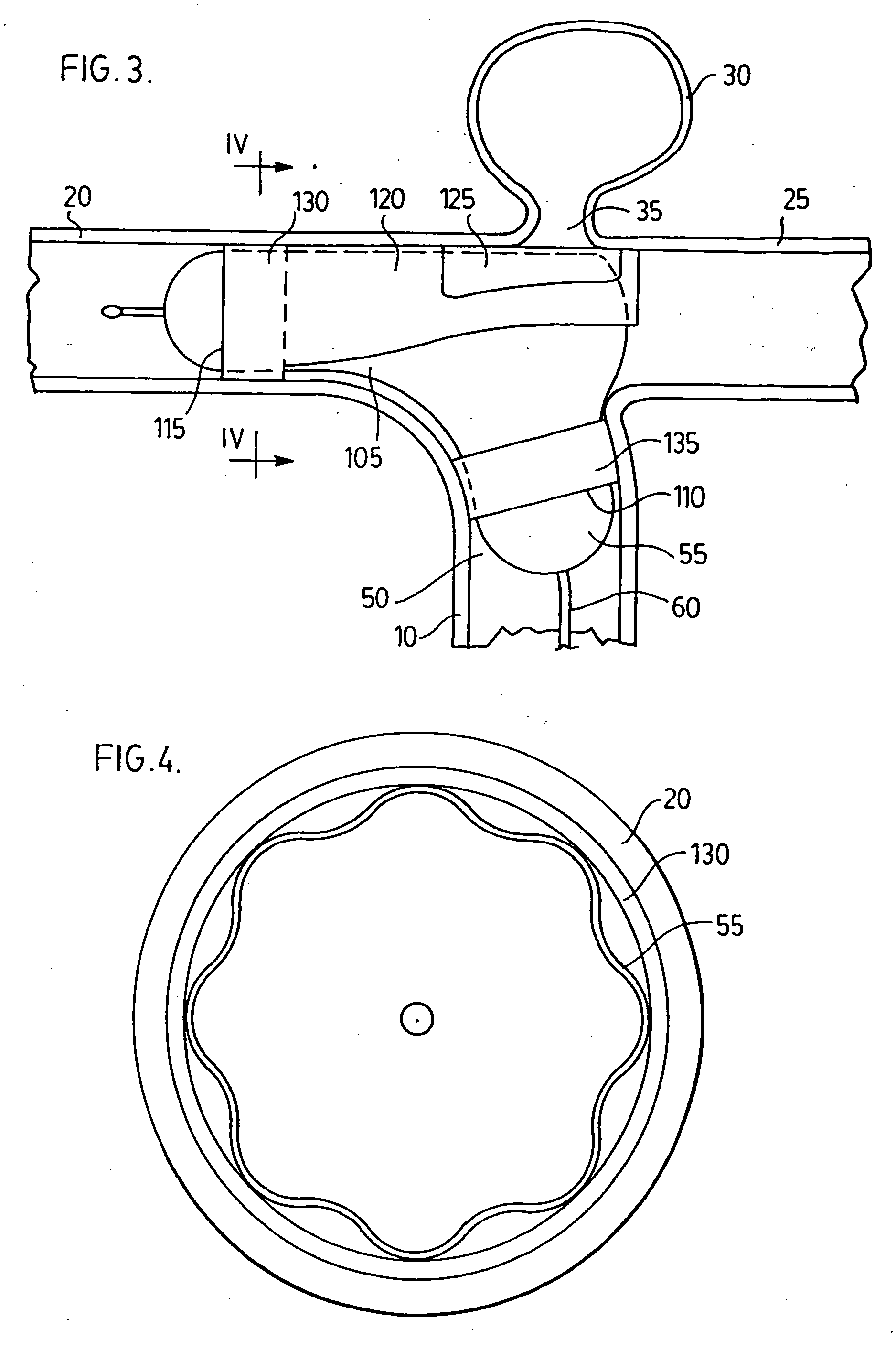 Endovascular prosthesis