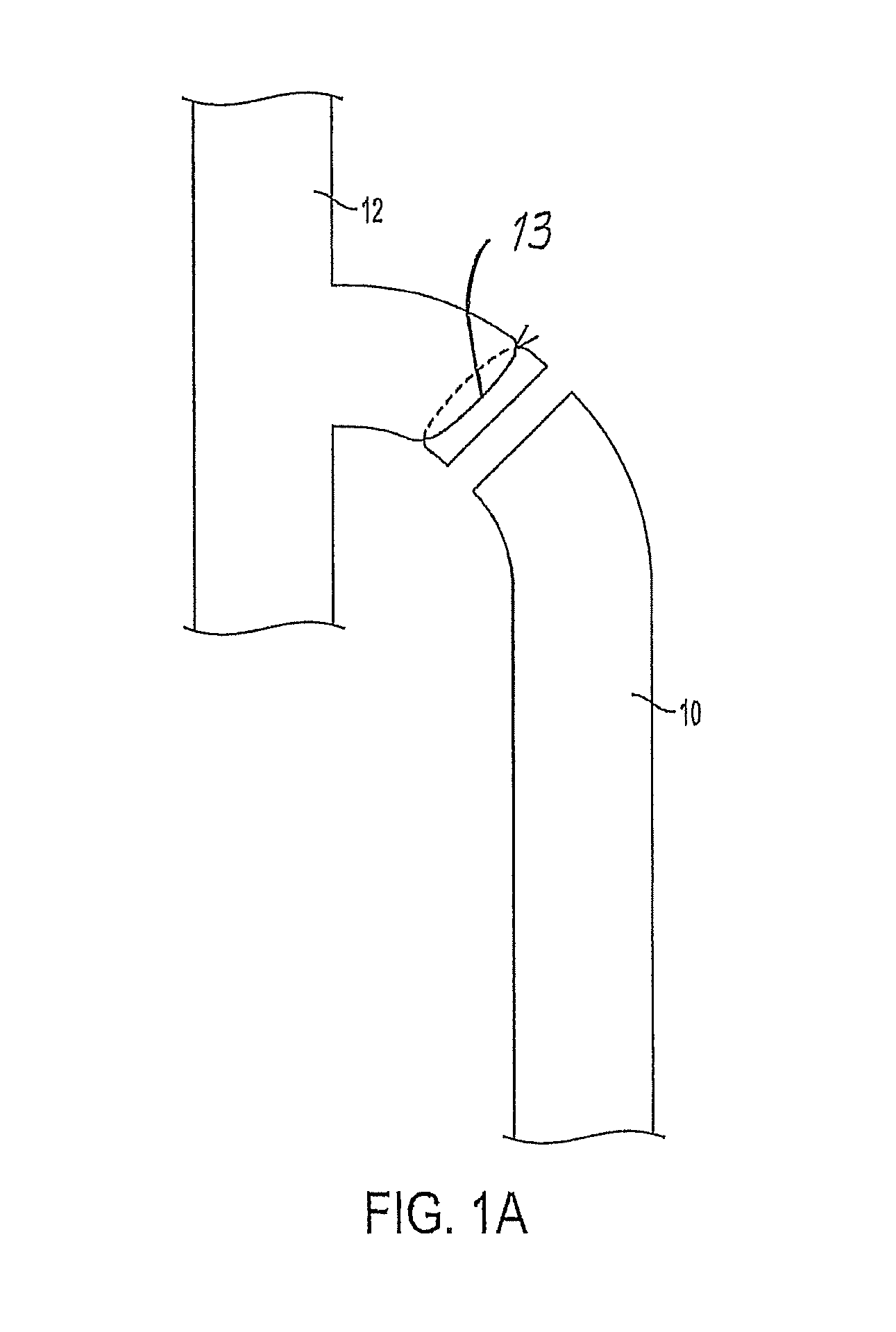 Venous closure catheter and method for sclerotherapy