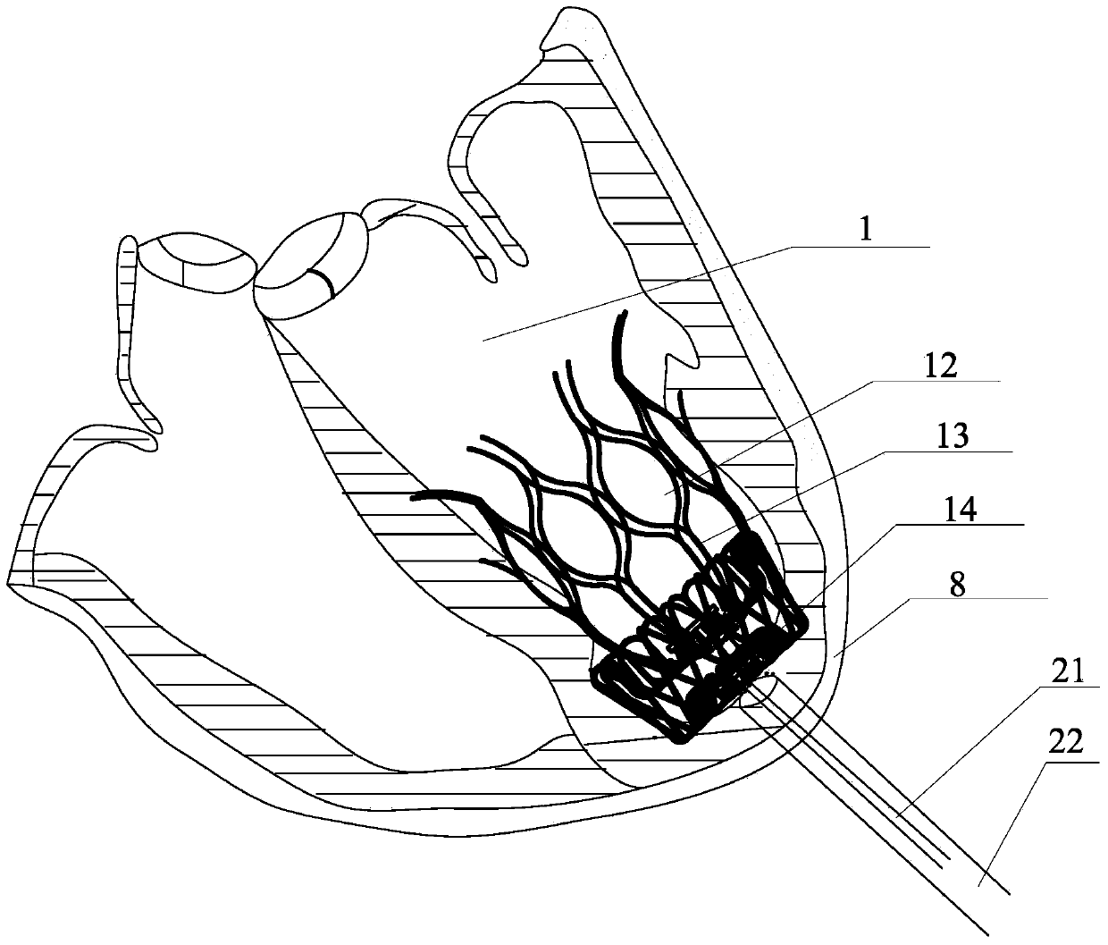 Left Ventricular Volume Reducing Device