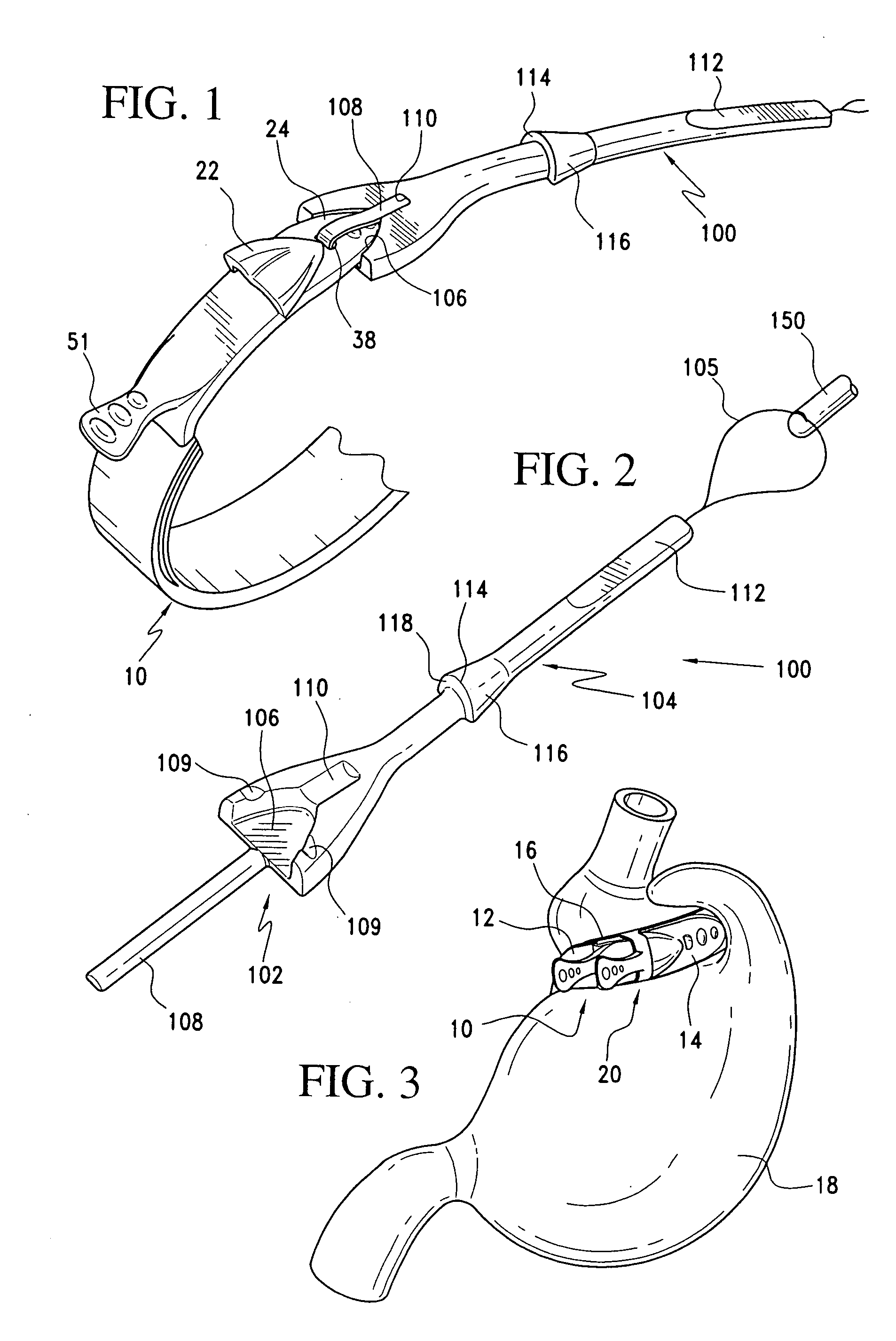 Gastric band composed of different hardness materials