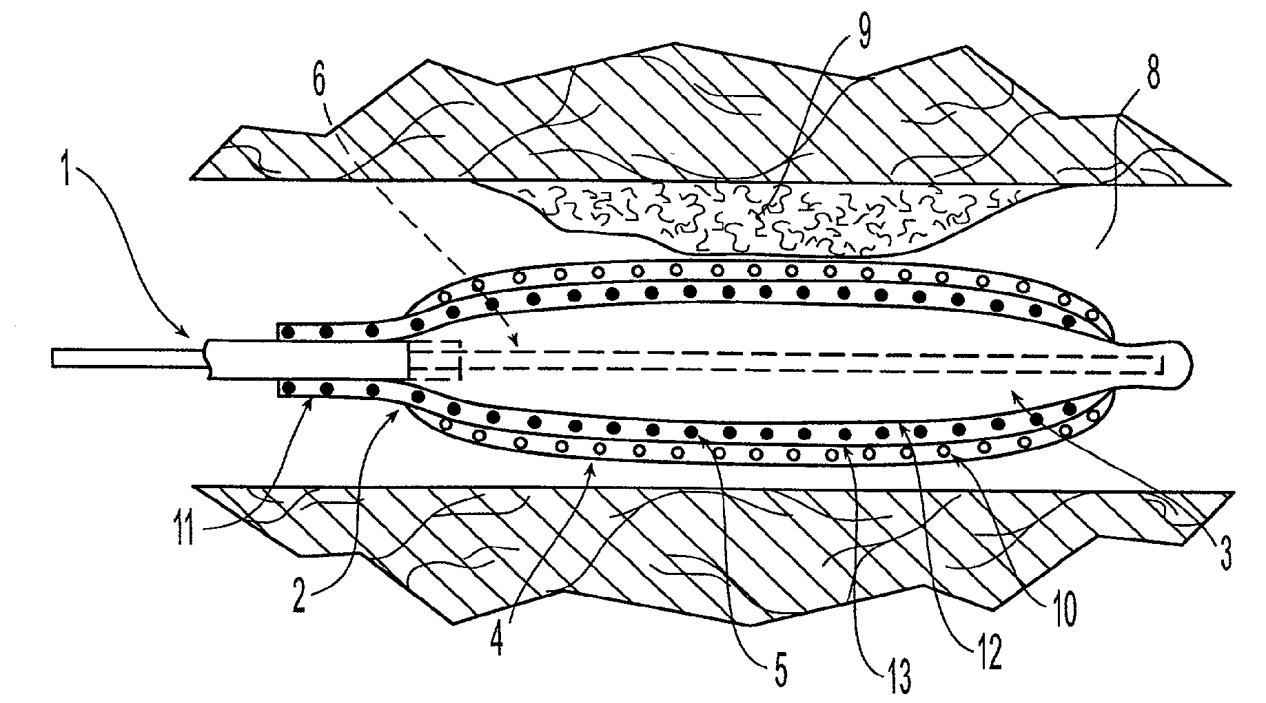 Medical device with sponge coating for controlled drug release