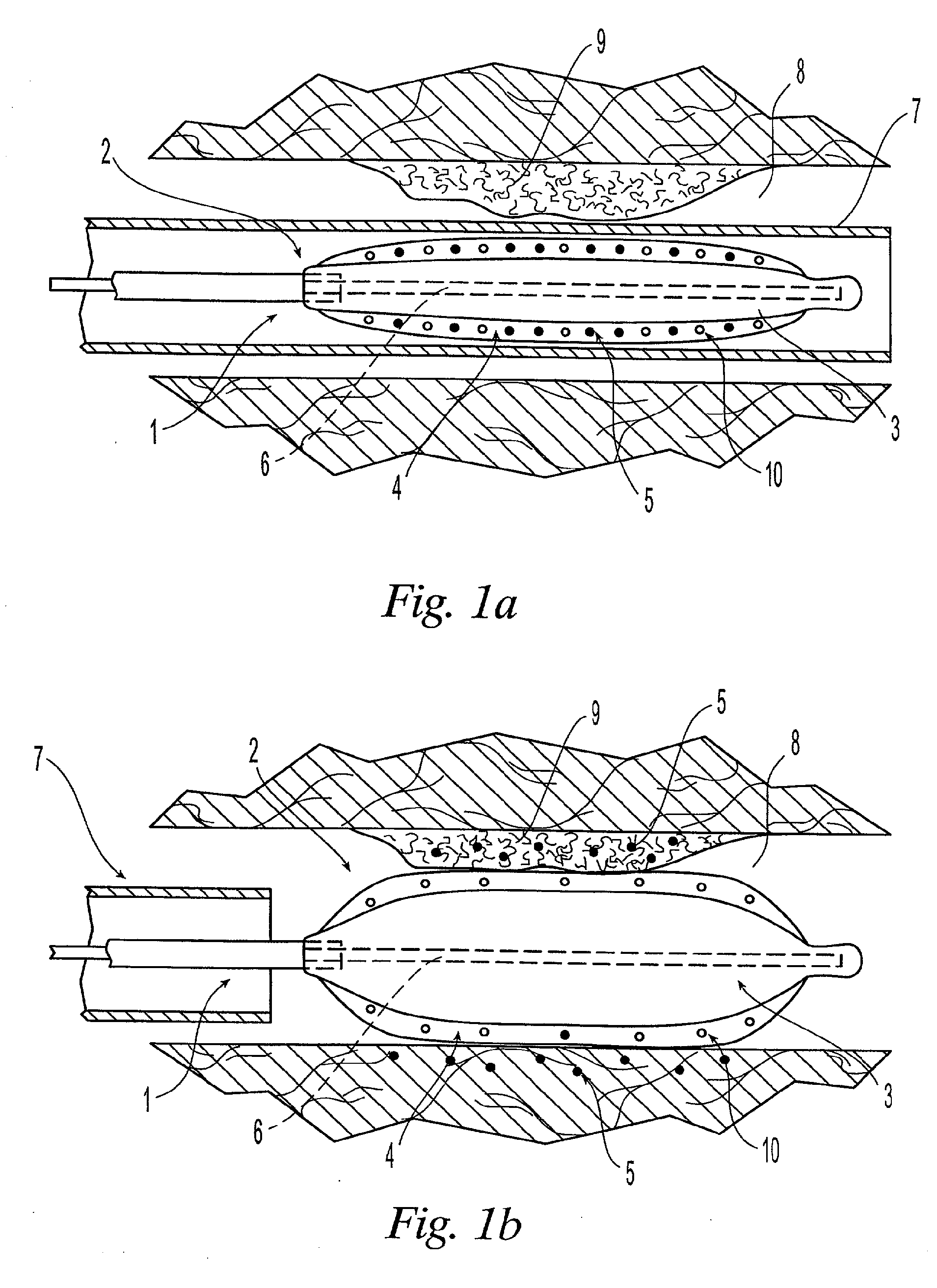 Medical device with sponge coating for controlled drug release