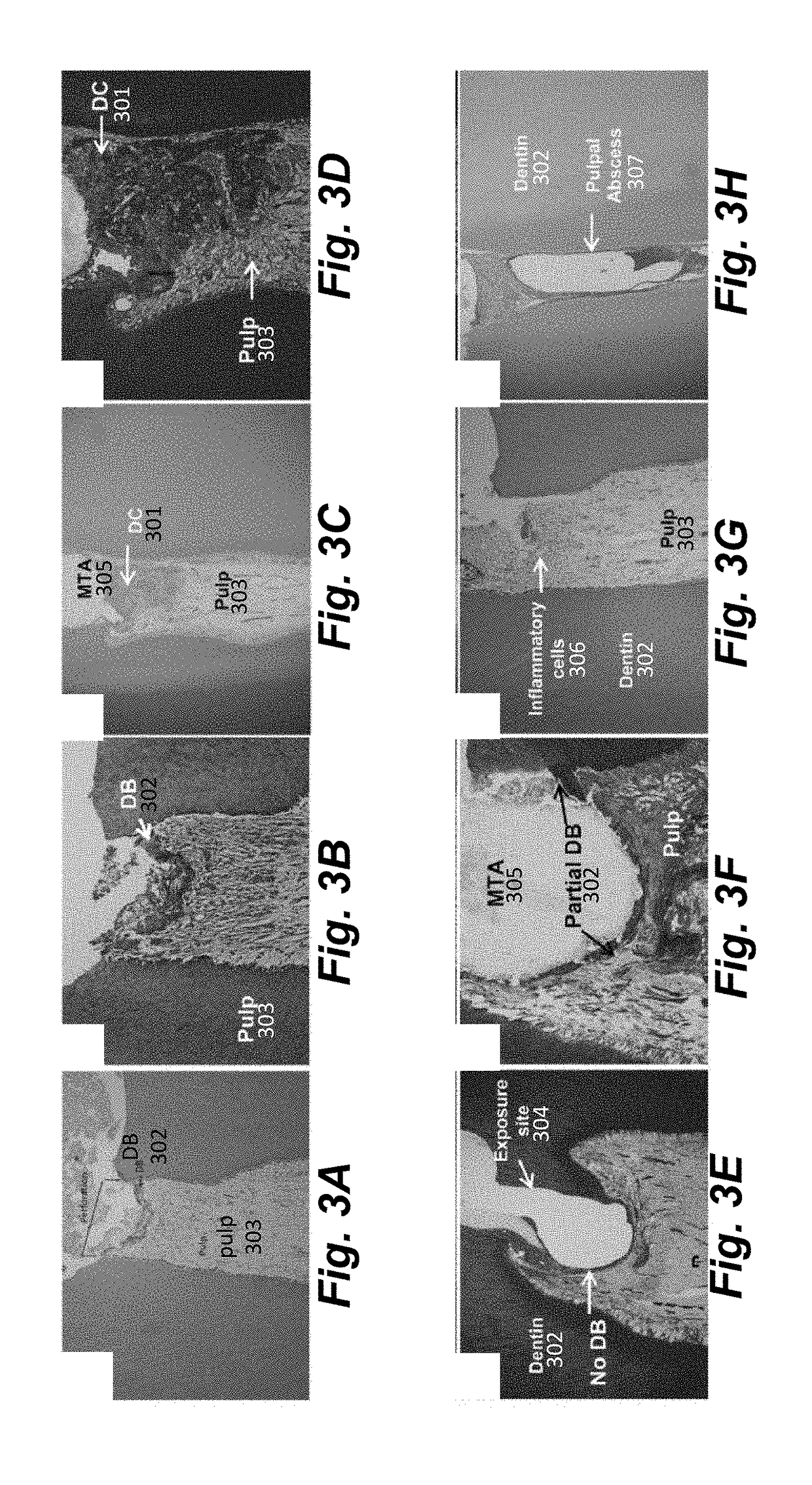 Dental composition and method of direct pulp capping