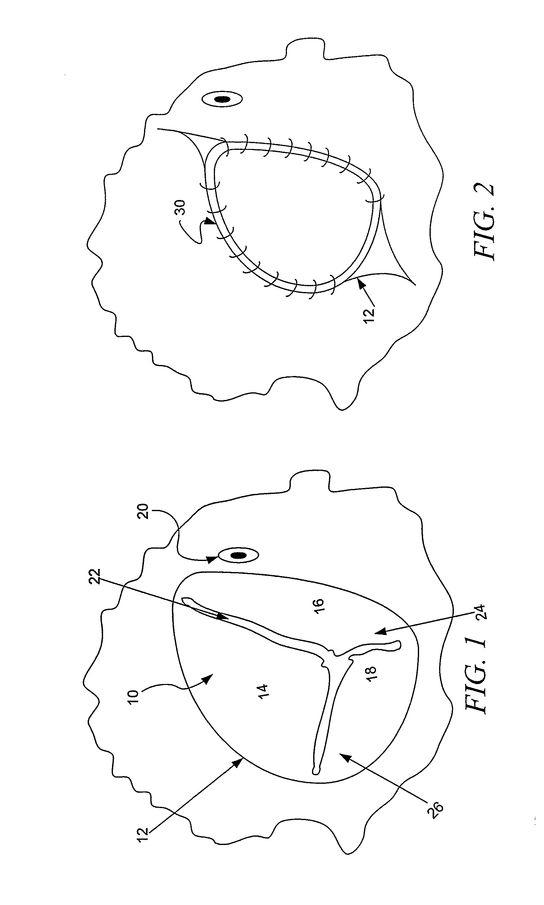 Method and apparatus for minimally invasive heart valve procedures