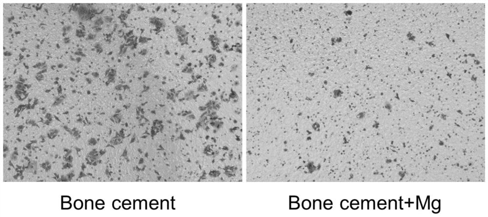 Preparation method of tumor bone cutting edge filler for preventing prosthesis loosening and tumor postoperative recurrence