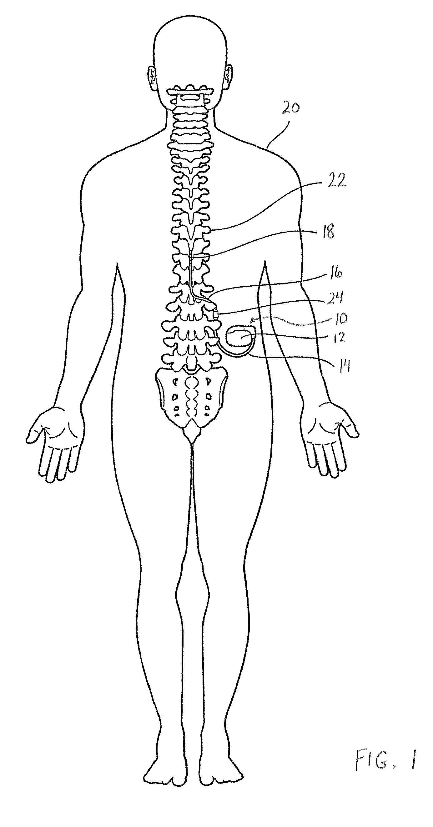 Discontinuous conductive filler polymer-matrix composites for electromagnetic shielding