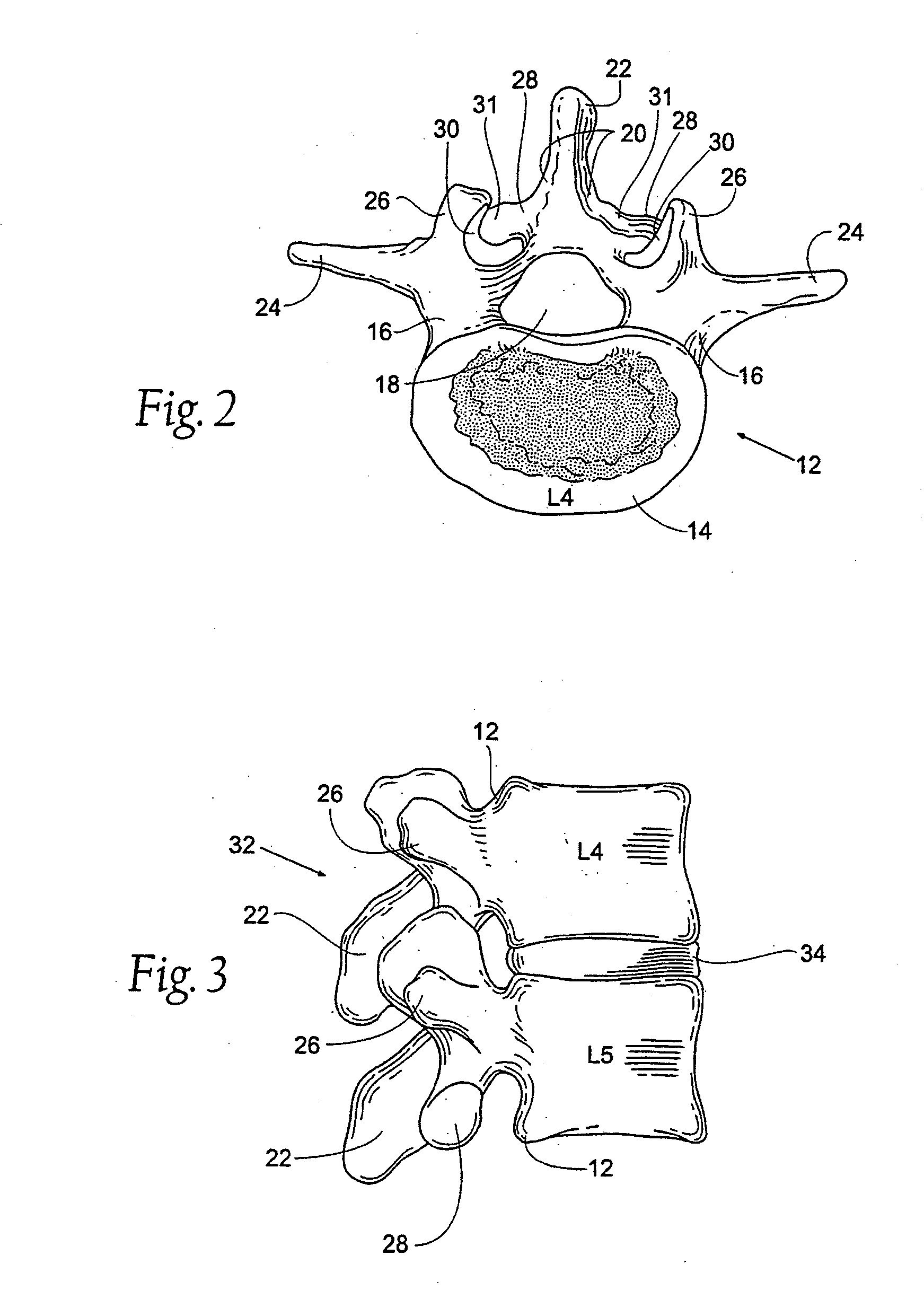 Prostheses systems and methods for replacement of natural facet joints with artificial facet joint surfaces