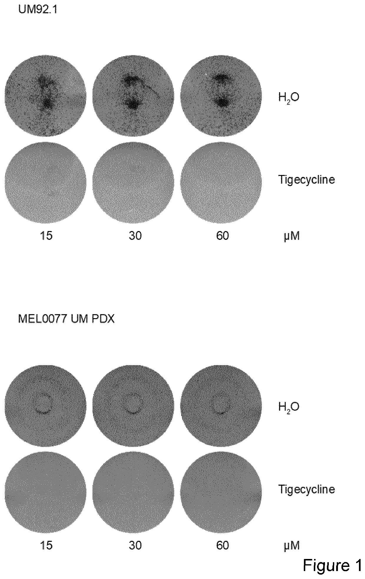 Uveal melanoma treatment