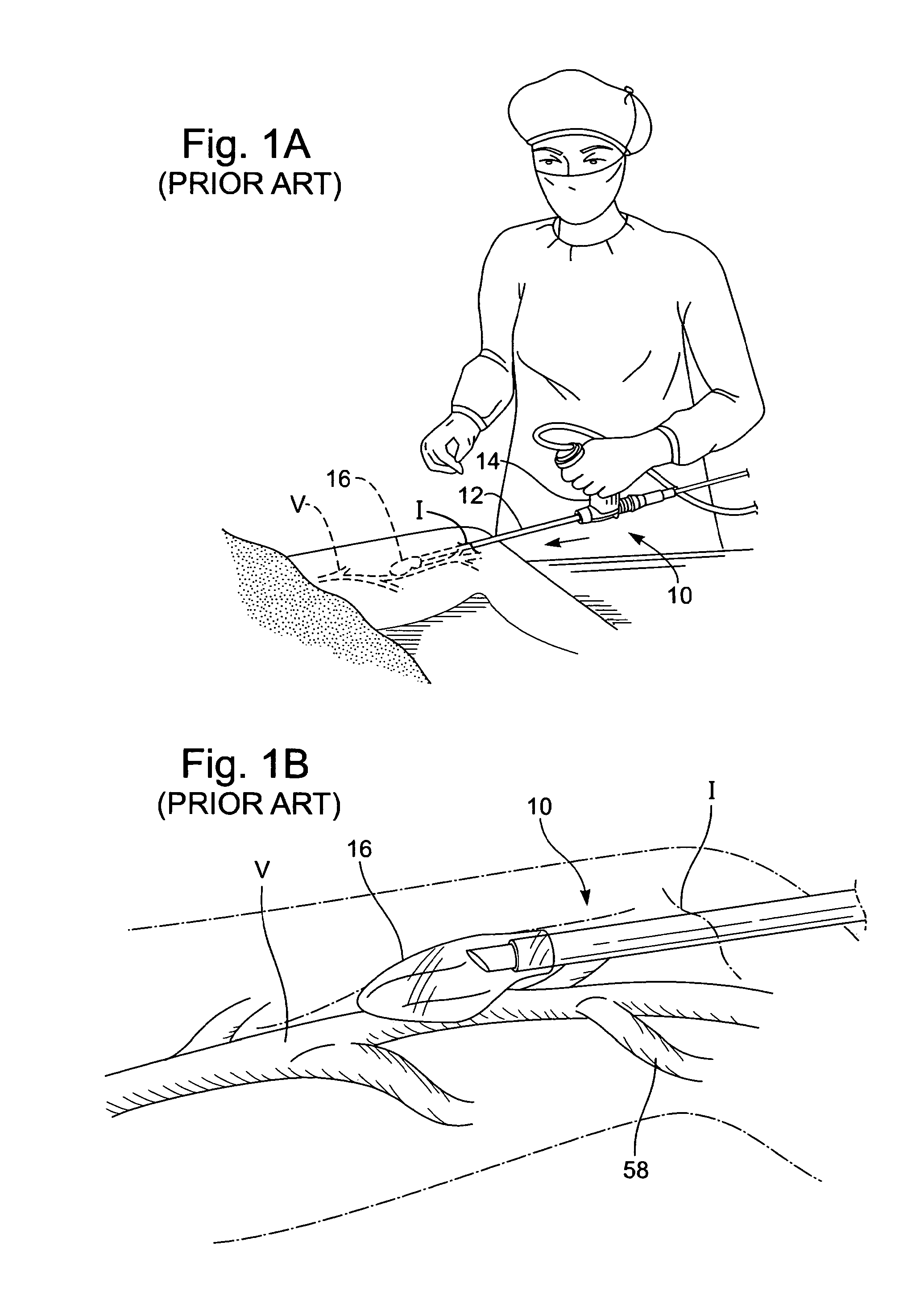 Modular vessel harvesting system and method