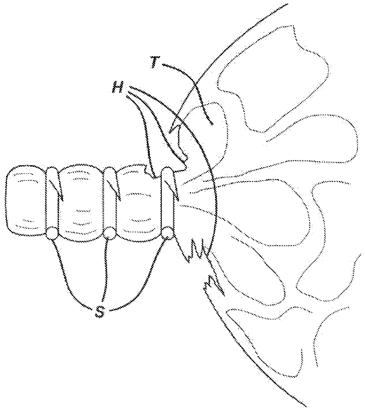 Woven and fibrous materials for reinforcing staple threads