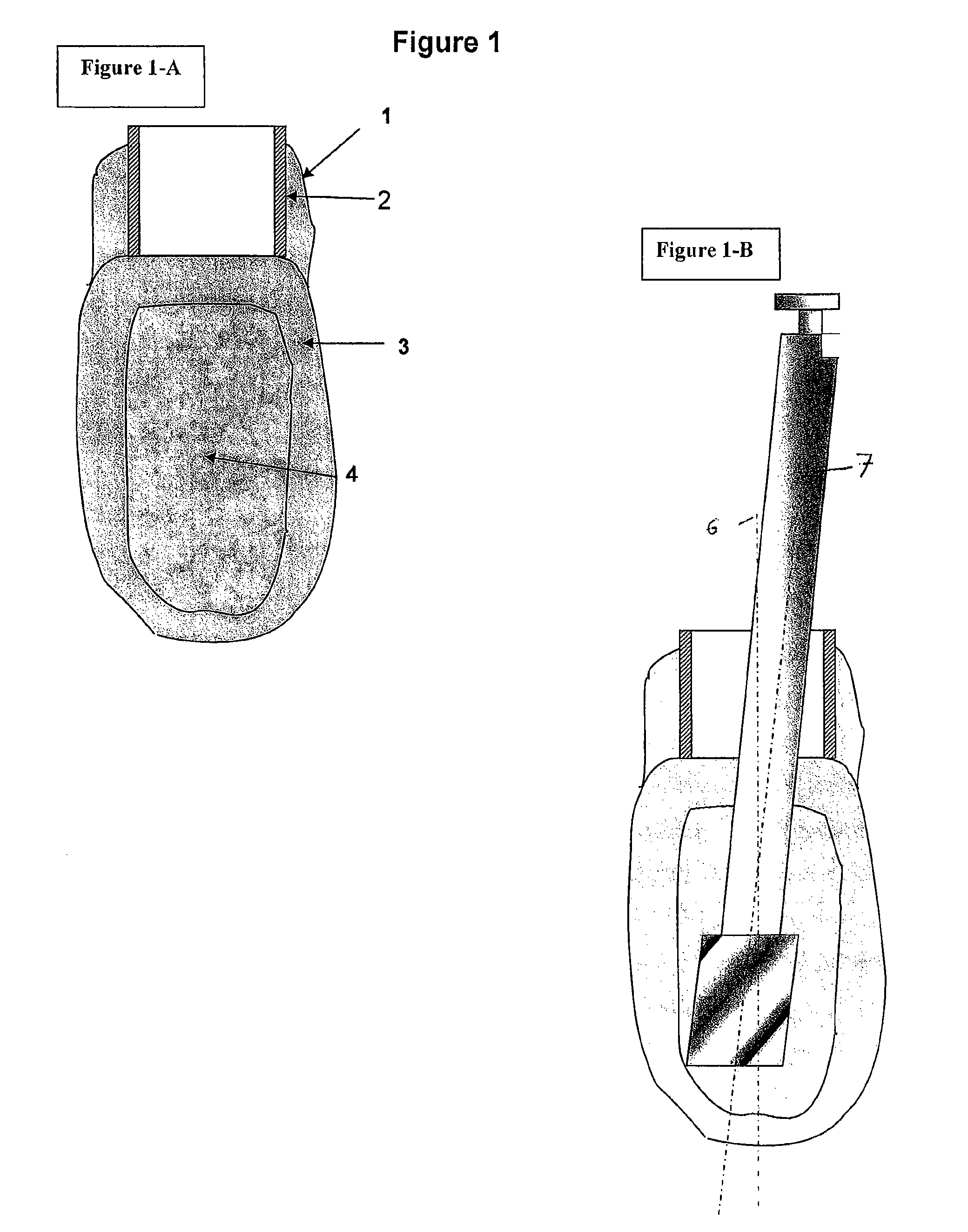 Bone modelling and guide device for preparing bone sites for implant surgery