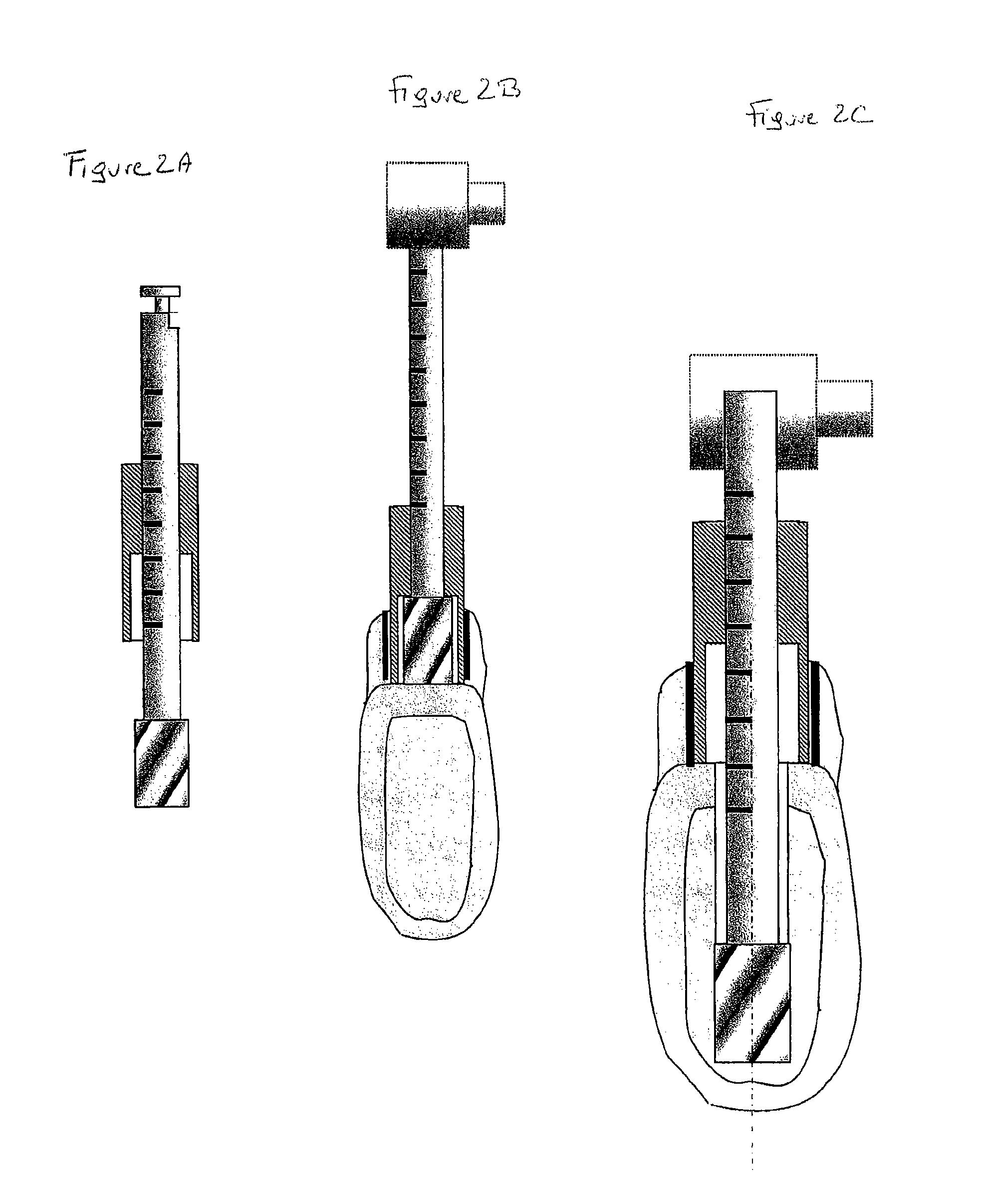 Bone modelling and guide device for preparing bone sites for implant surgery