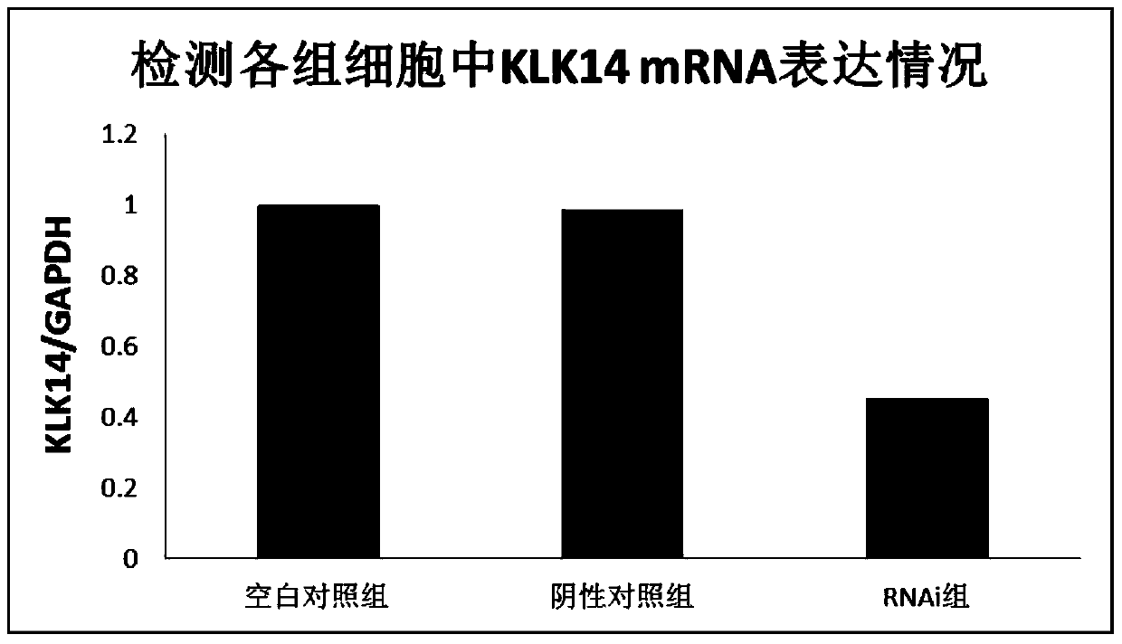 A new target gene for diagnosis and treatment of tongue squamous cell carcinoma and its application