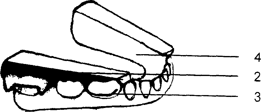 Cheek tooth inclined guide plate appliance