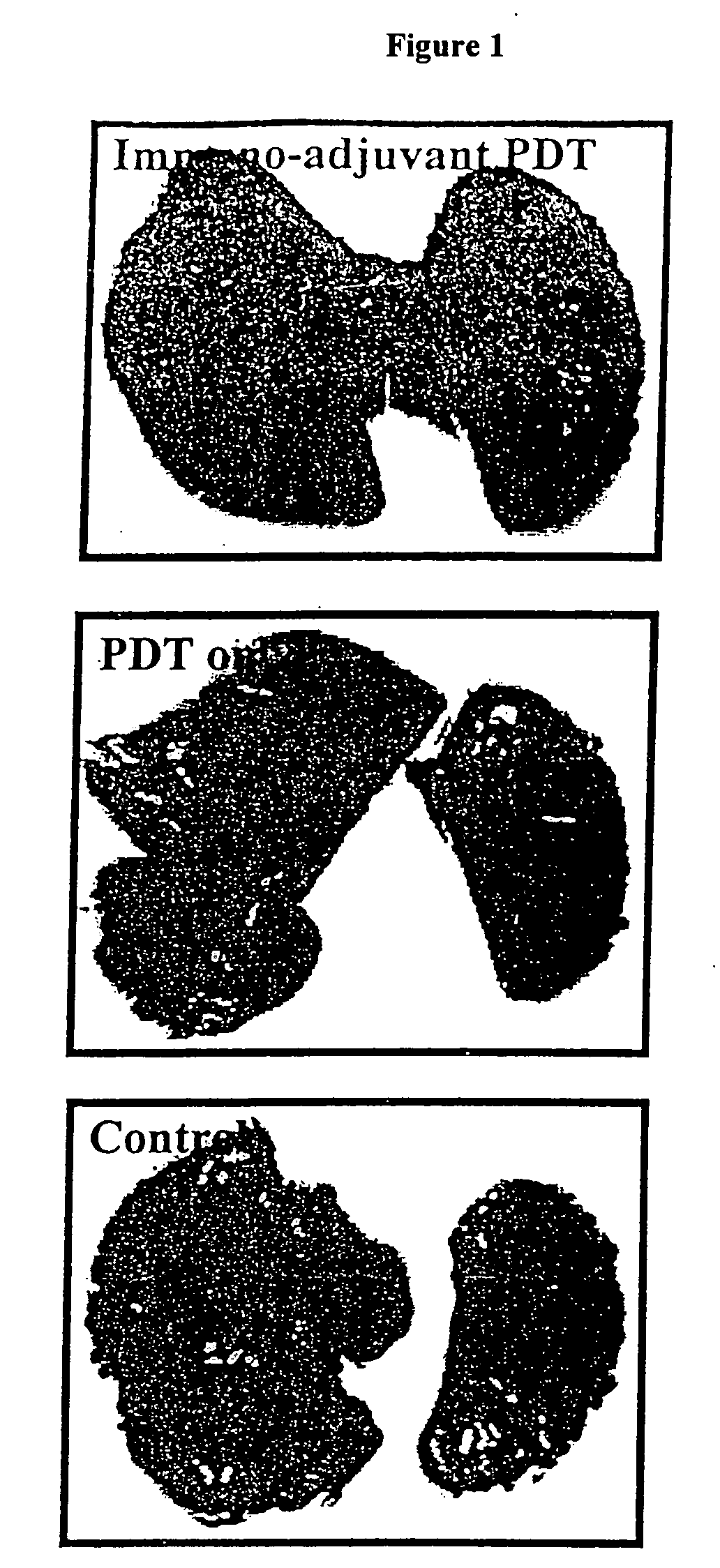 Immuno-adjuvant PDT treatment of metastatic tumors