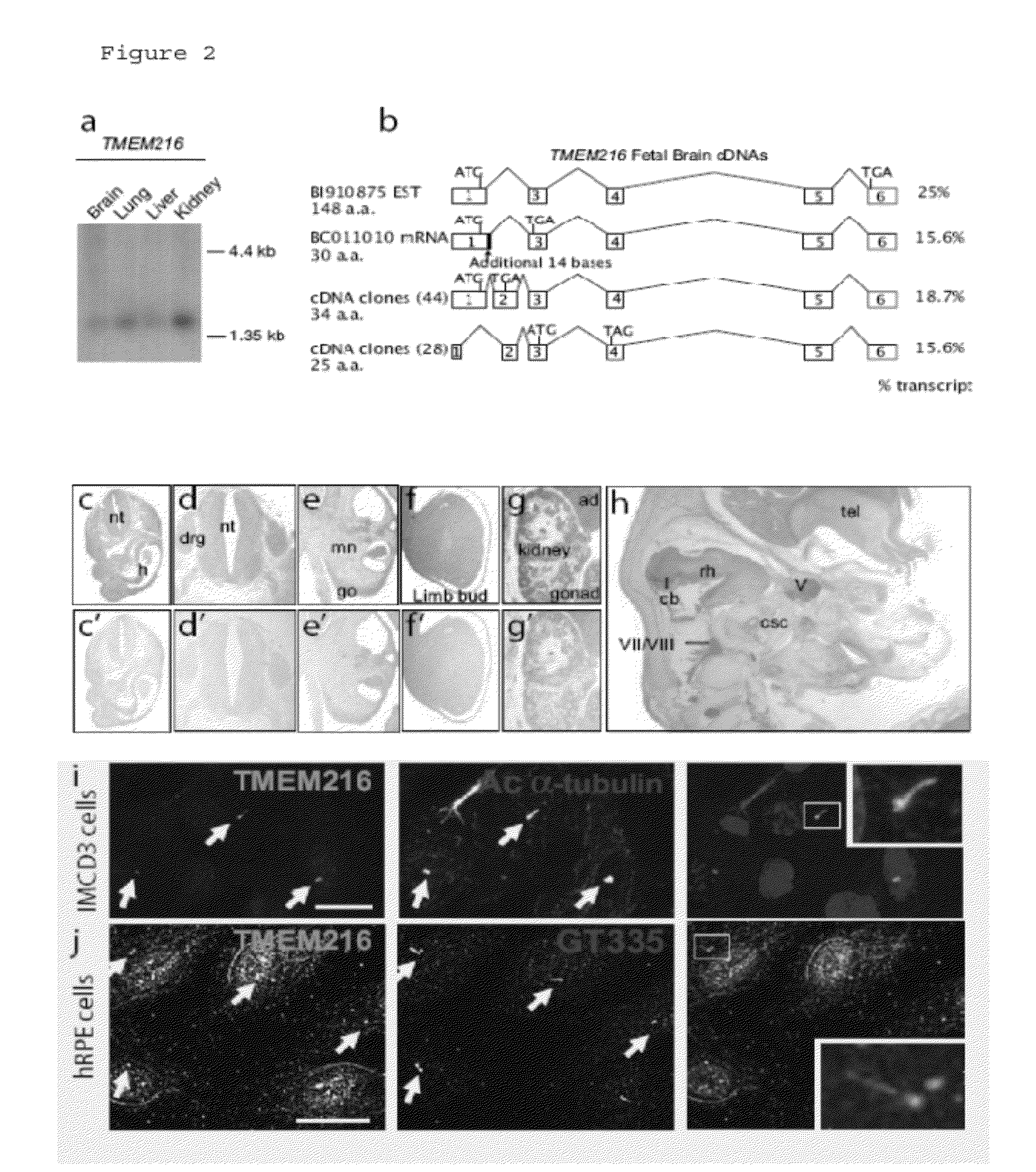 Compositions and methods for determining genetic polymorphisms in the tmem216 gene