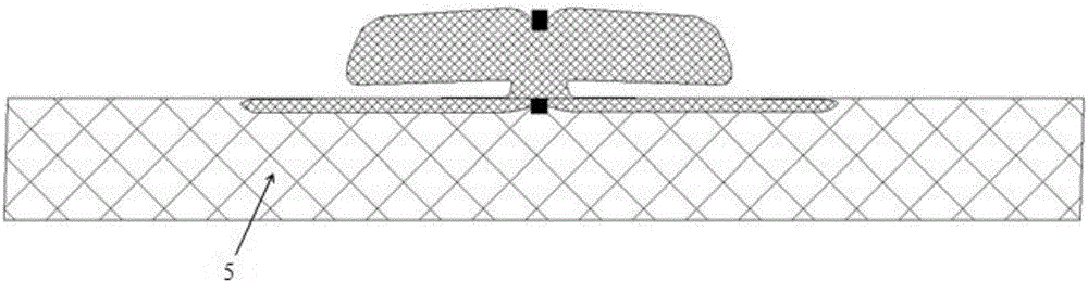 Intracranial aneurysm interventional closure treatment device