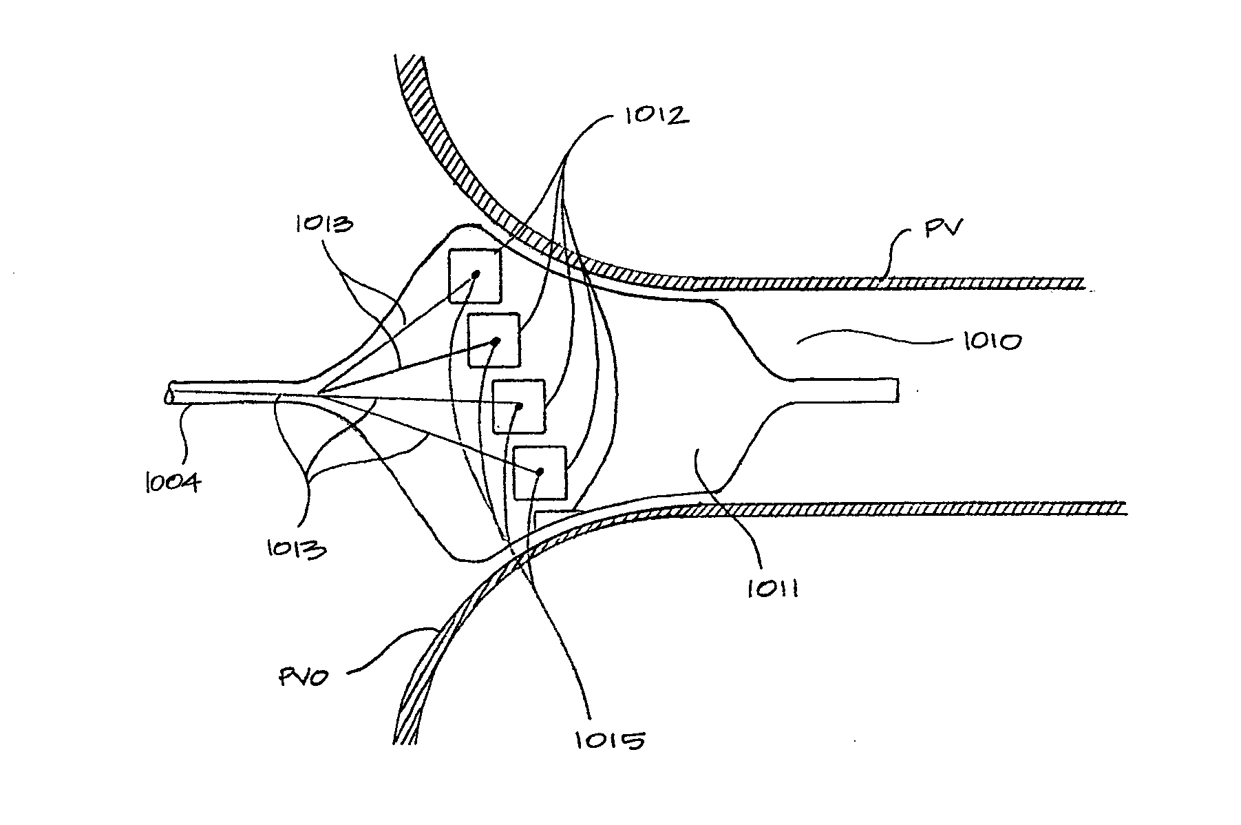 Devices and methods for denervation of the nerves surrounding the pulmonary veins for treatment of atrial fibrillation