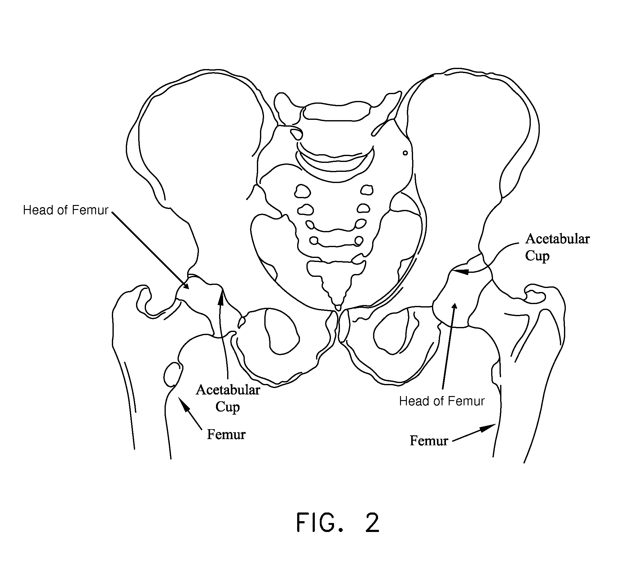 Method and apparatus for attaching tissue to bone, including the provision and use of a novel knotless suture anchor system