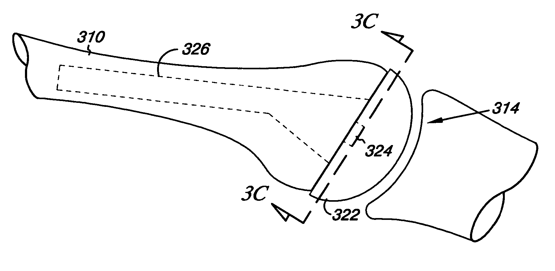 Humeral joint prosthesis