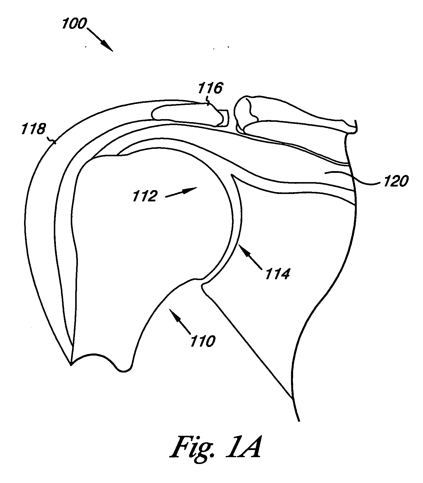 Humeral joint prosthesis