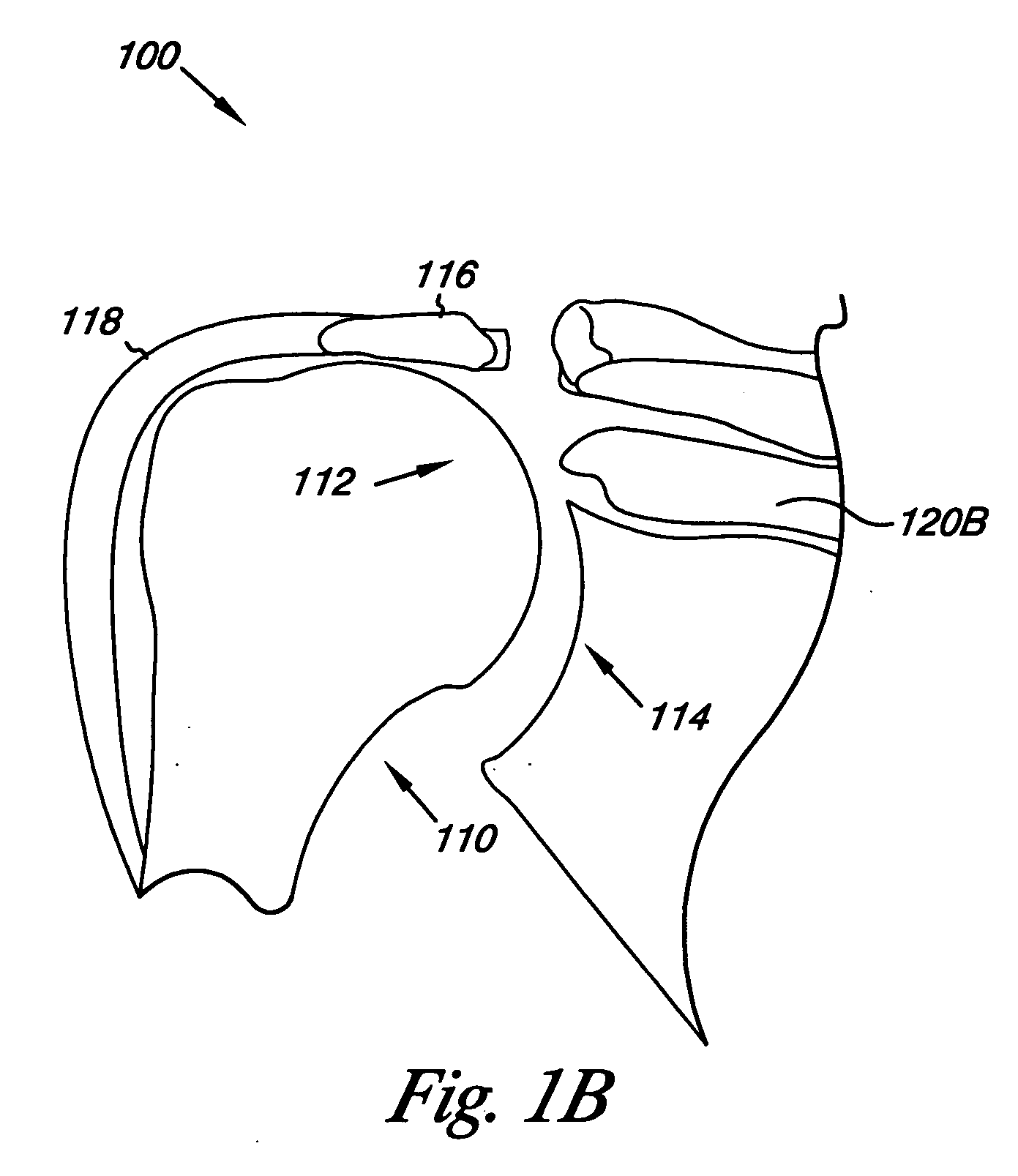 Humeral joint prosthesis